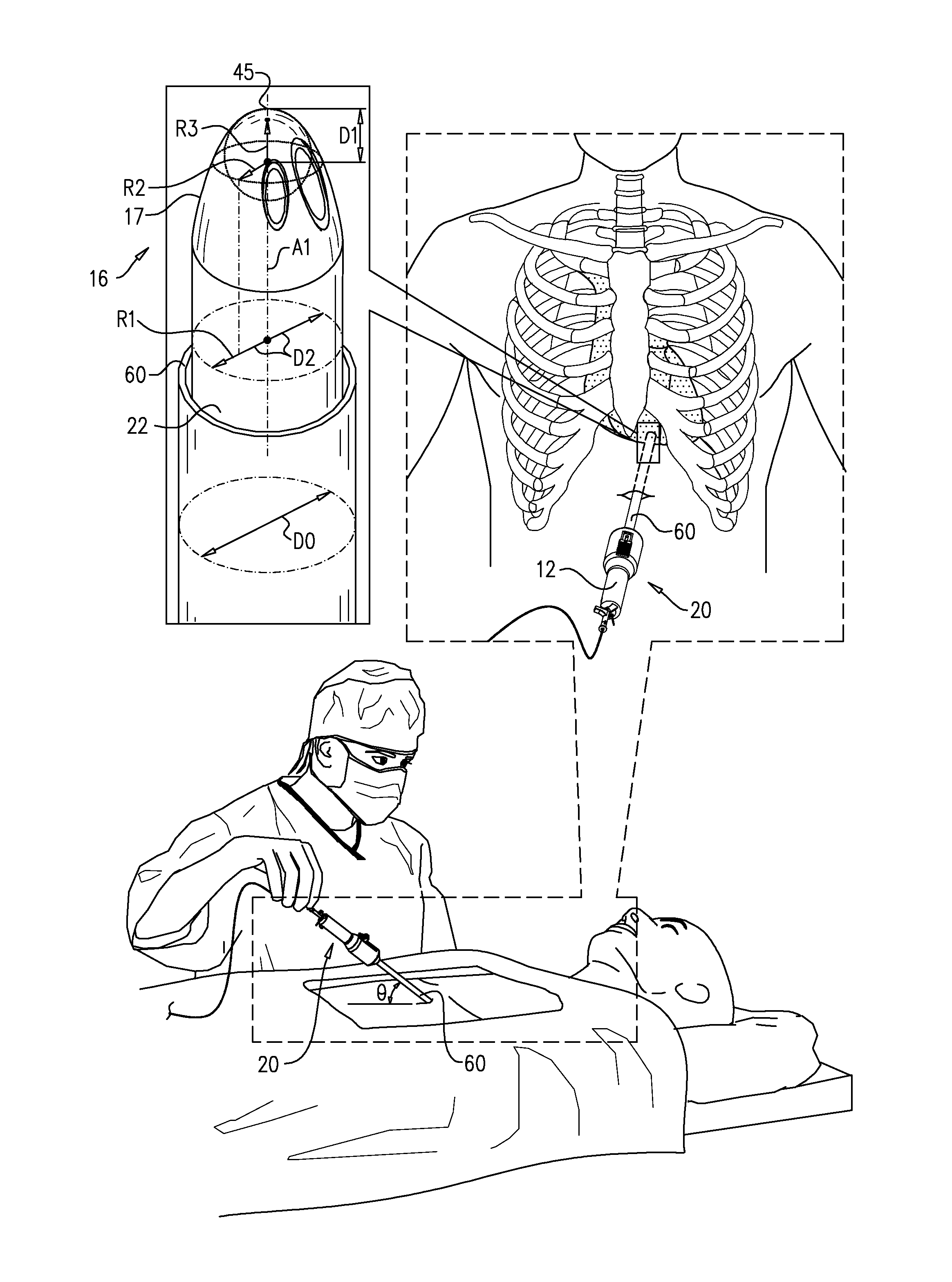 Pericardial access device