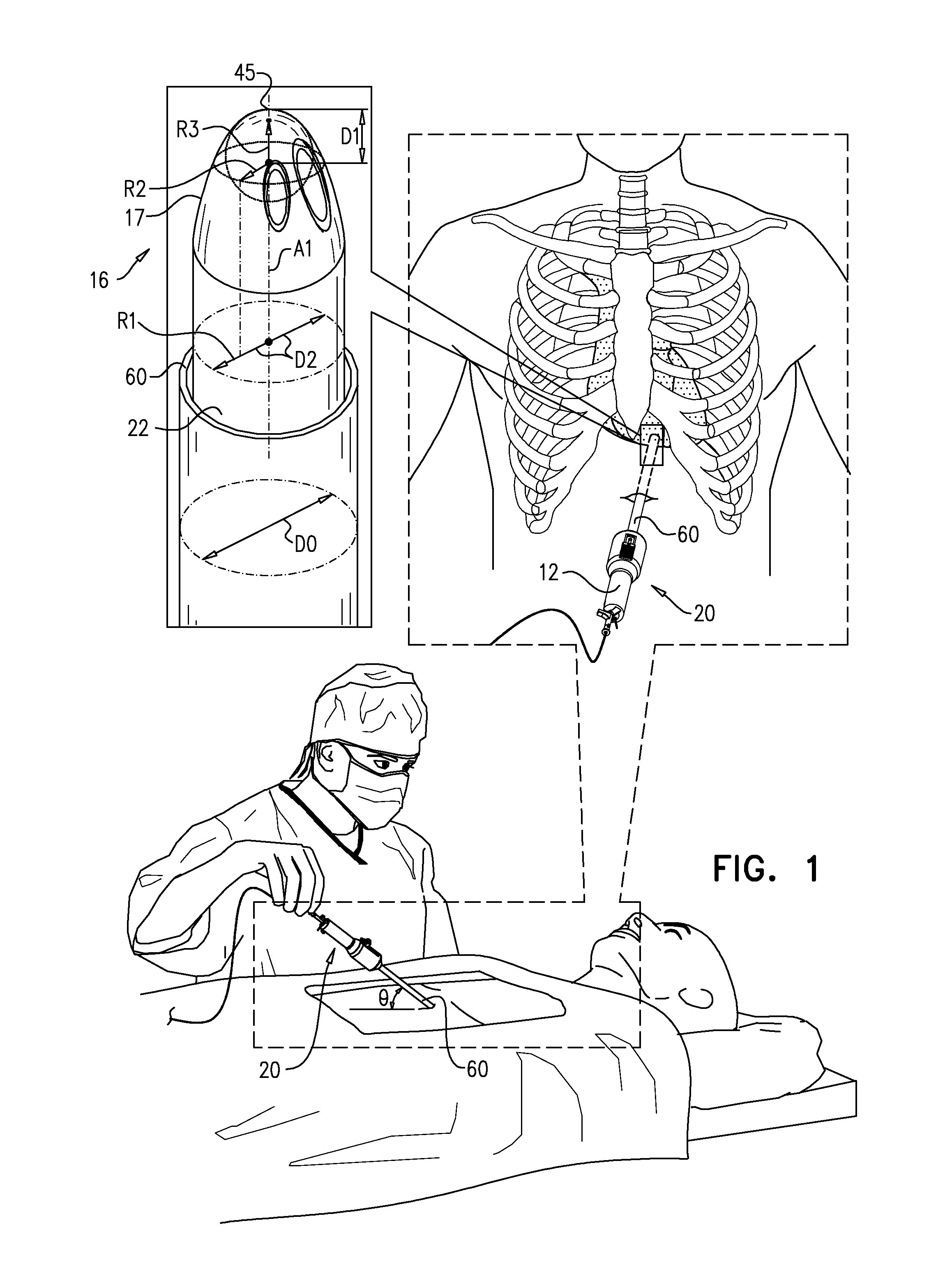 Pericardial access device