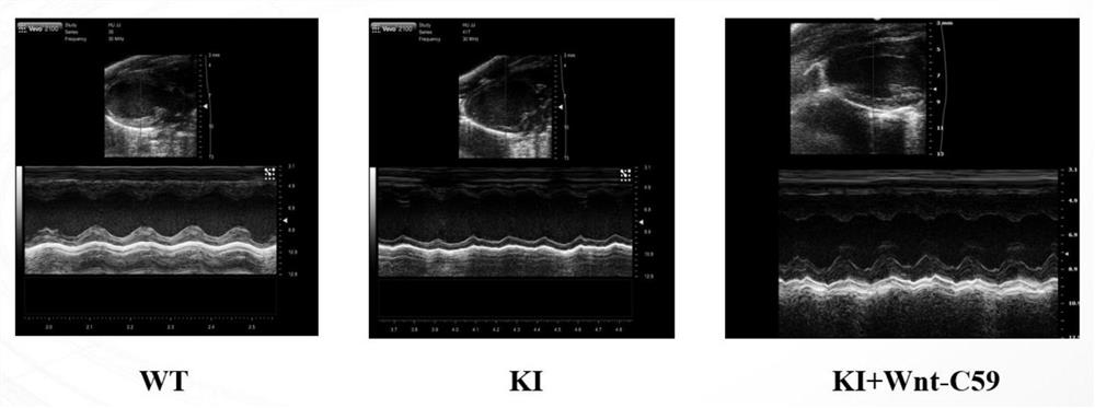 Application of wnt inhibitor wnt-c59 in preparation of medicine for scn5a mutation-induced dilated cardiomyopathy