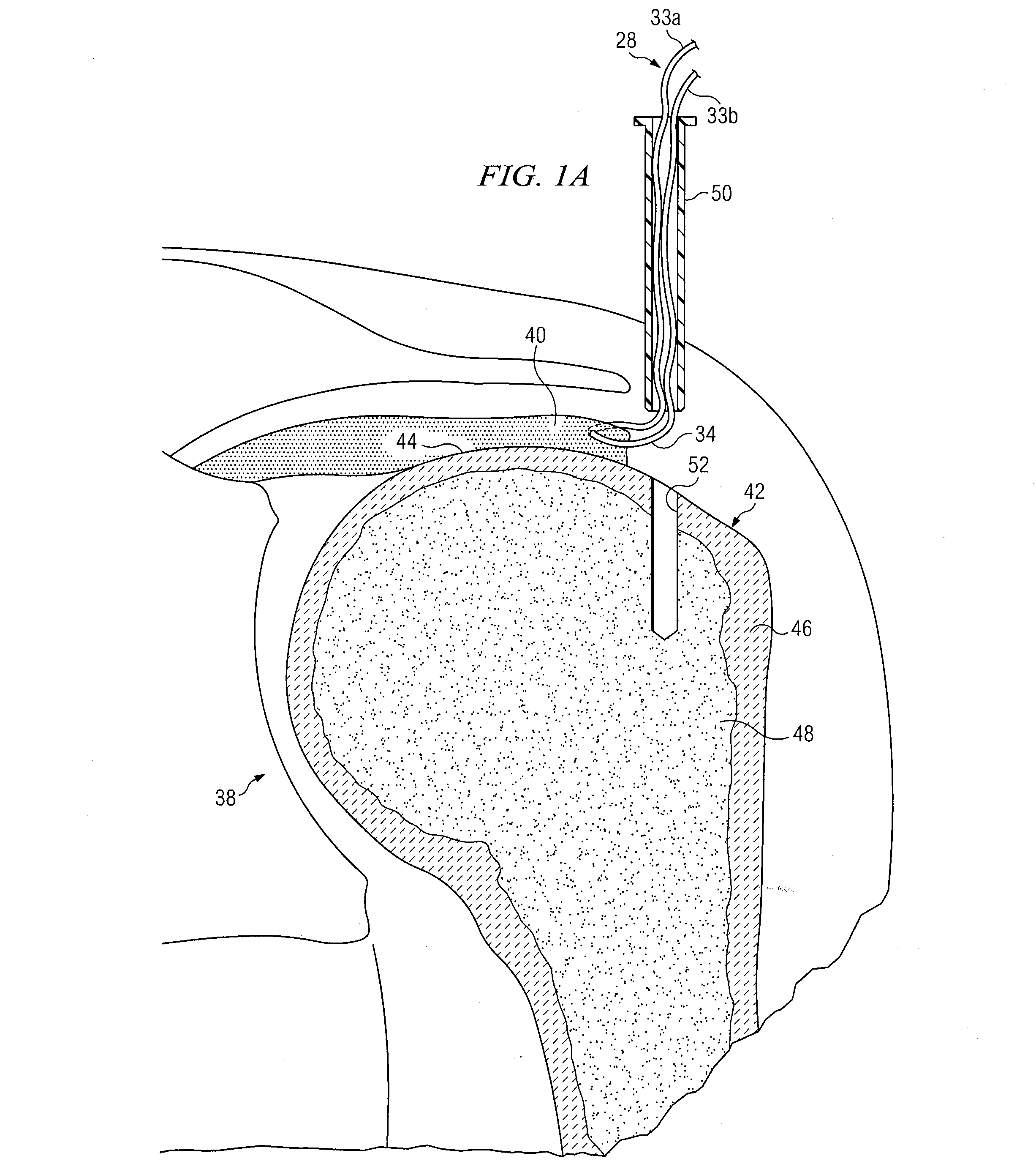 Knotless suture anchor having discrete polymer components and related methods