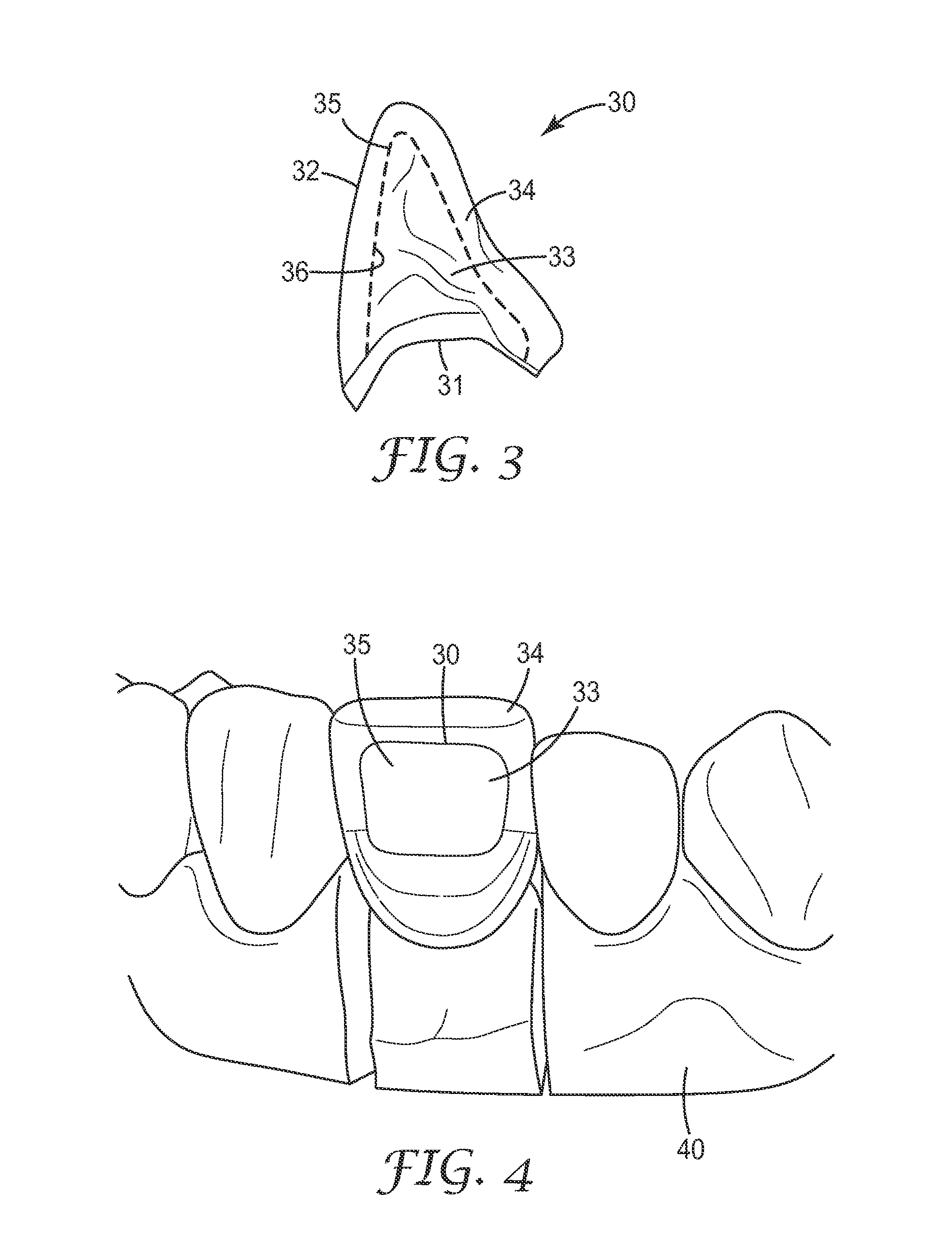 Method and system for making a dental restoration