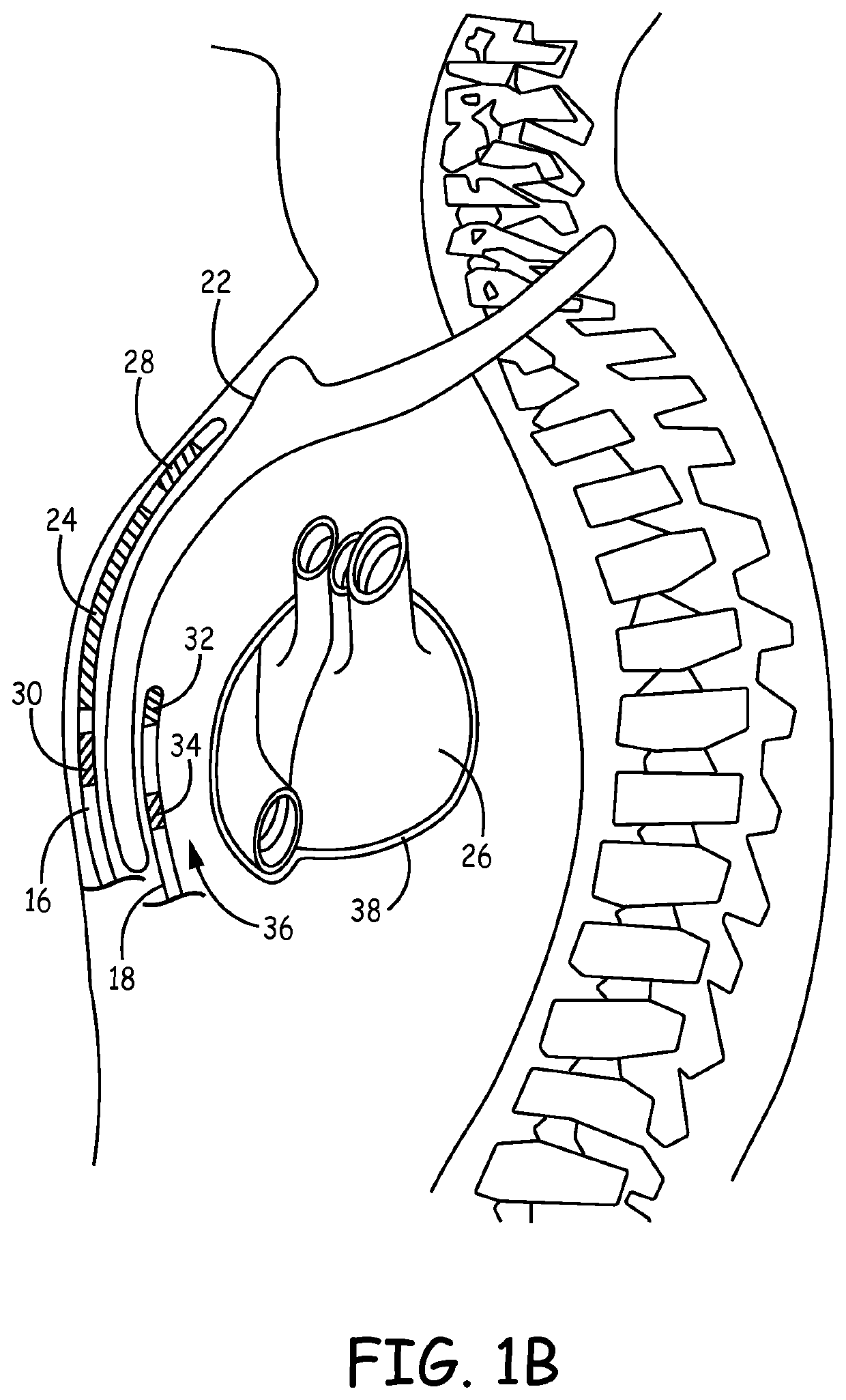 Implantable cardioverter-defibrillator (ICD) system including substernal pacing lead