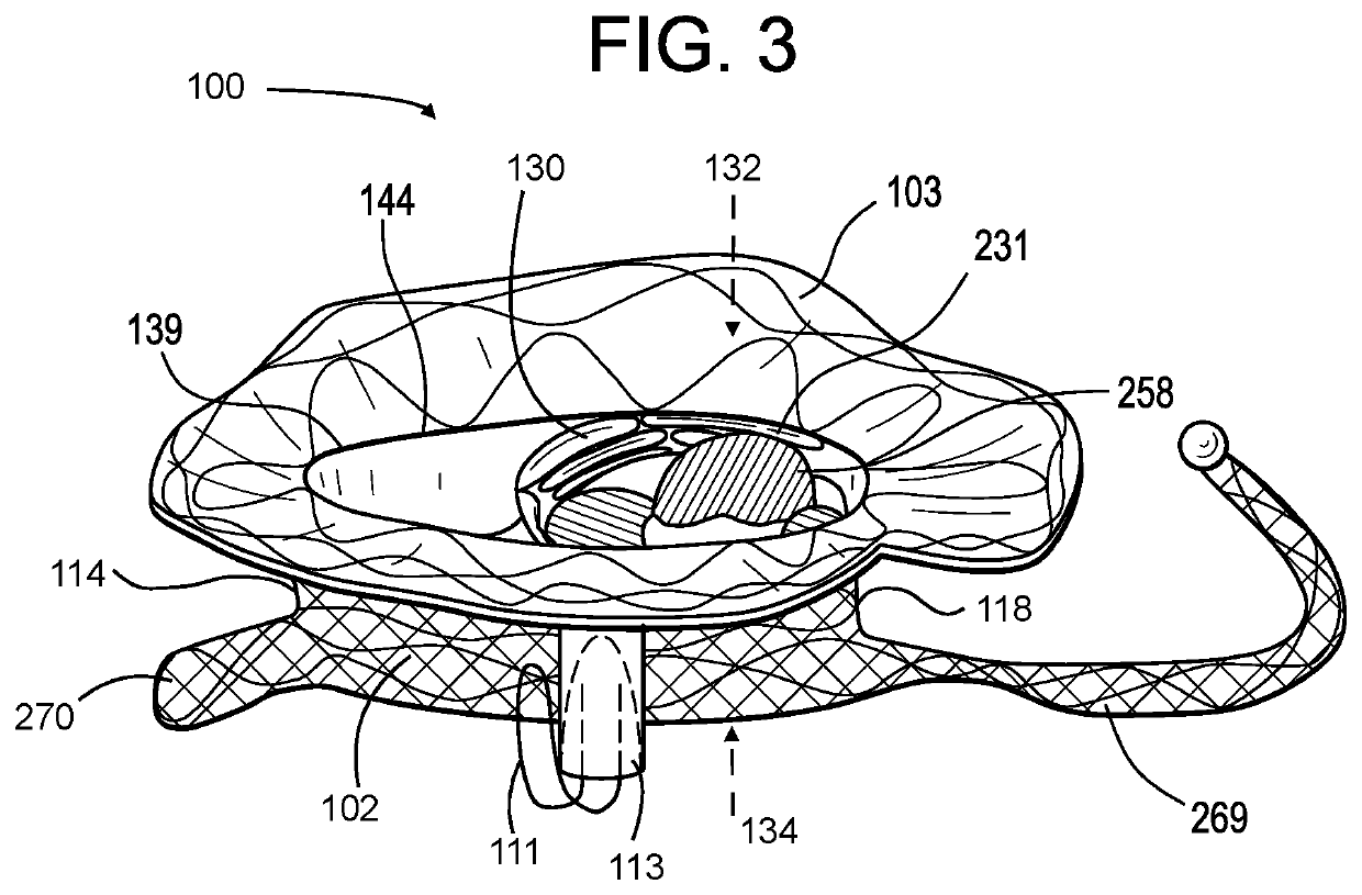 Proximal, distal, and anterior anchoring tabs for side-delivered transcatheter mitral valve prosthesis