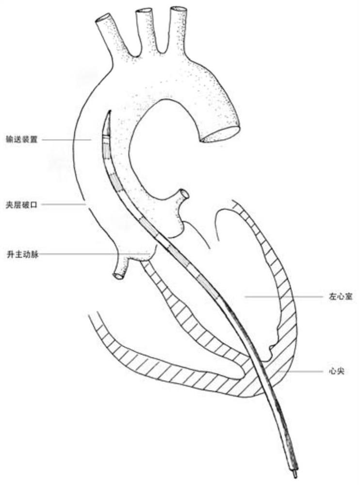 The anchoring of an anchoring of an anatomical anchoring and the anchoring of the anchor and the conveyor system