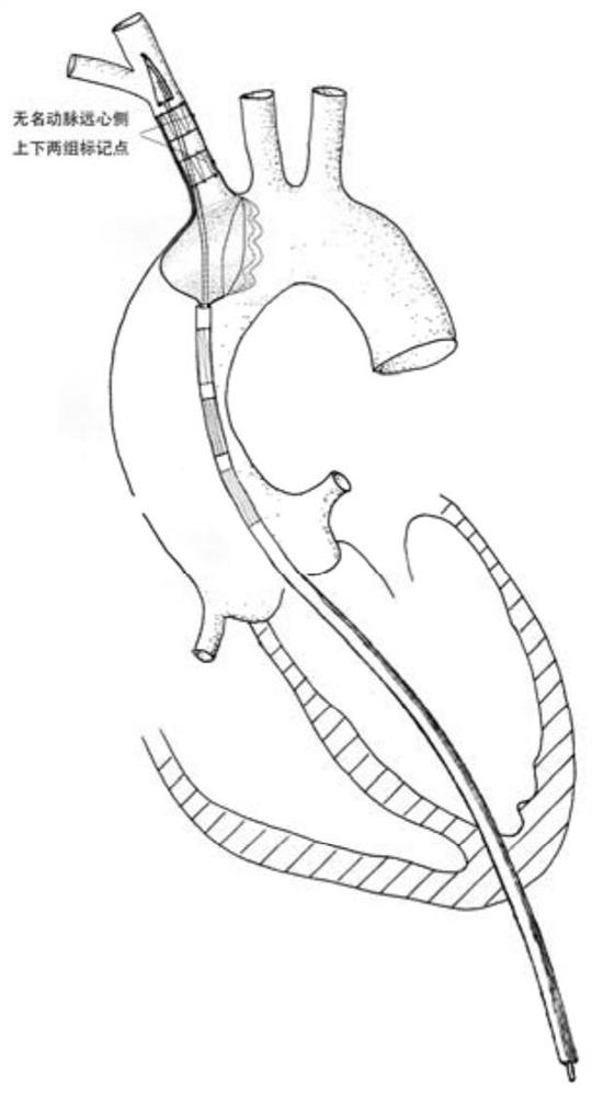 The anchoring of an anchoring of an anatomical anchoring and the anchoring of the anchor and the conveyor system