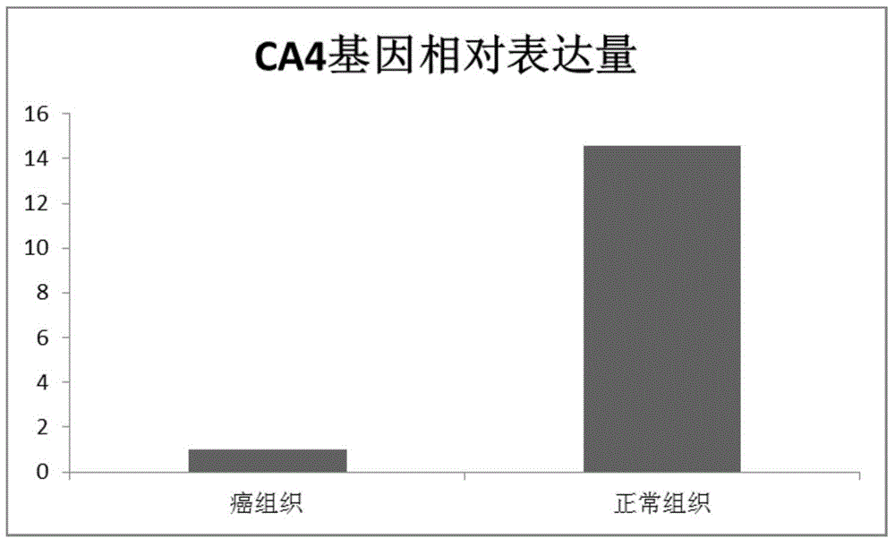 Application of carbonic anhydrase IV to preparing lung adenocarcinoma diagnostic preparation