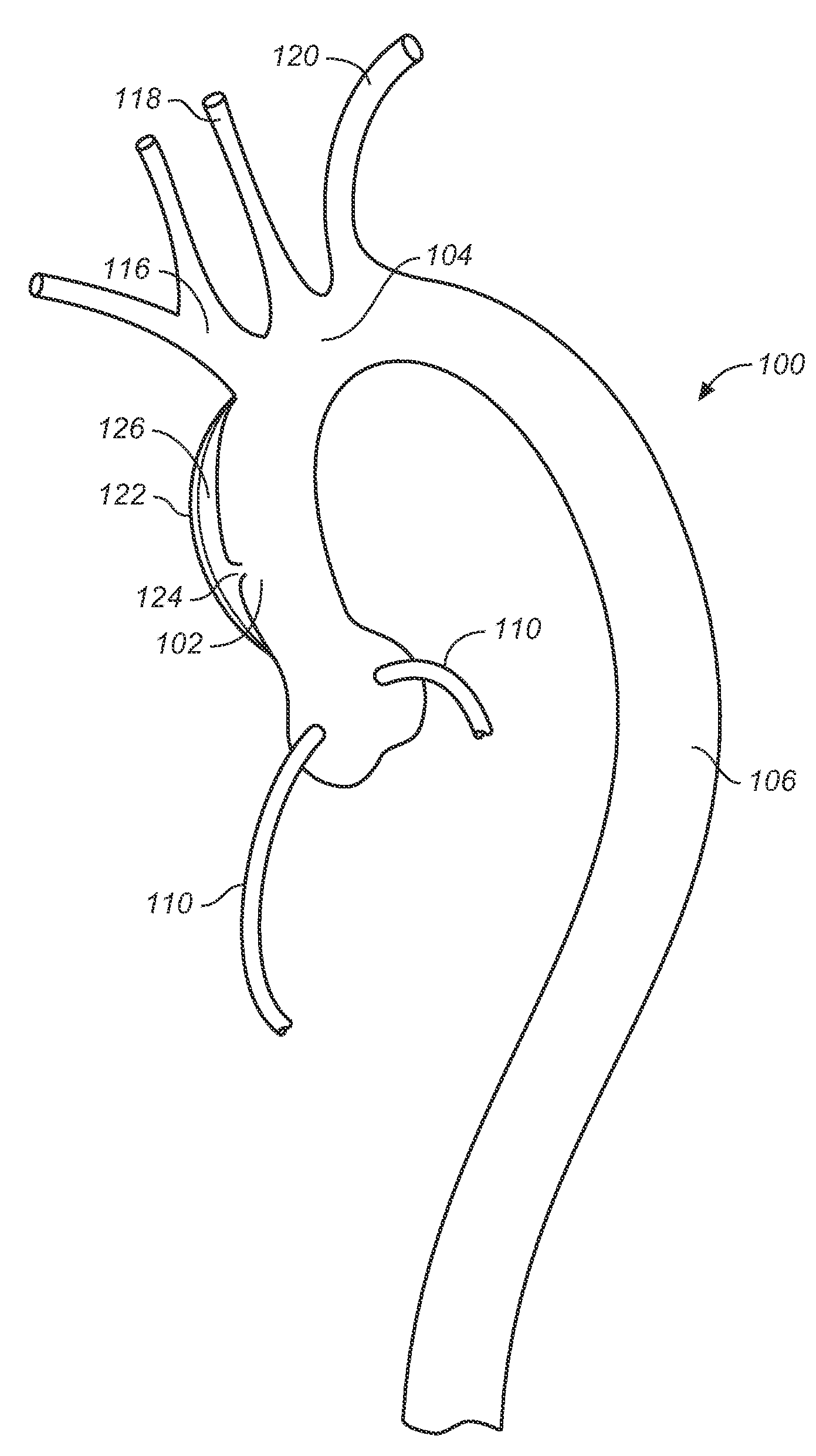 Endovascular Prosthesis for Ascending Aorta