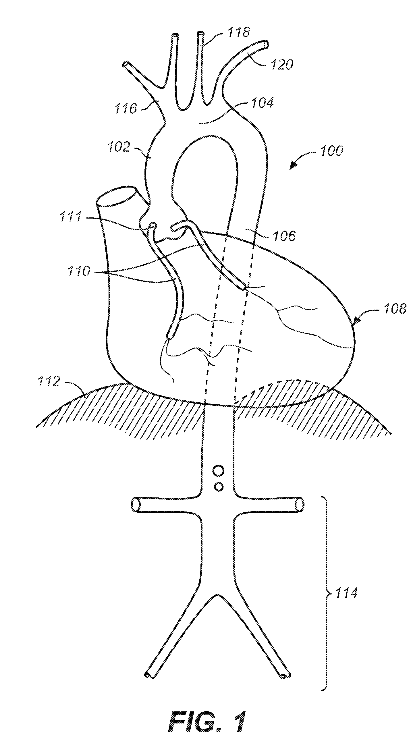 Endovascular Prosthesis for Ascending Aorta