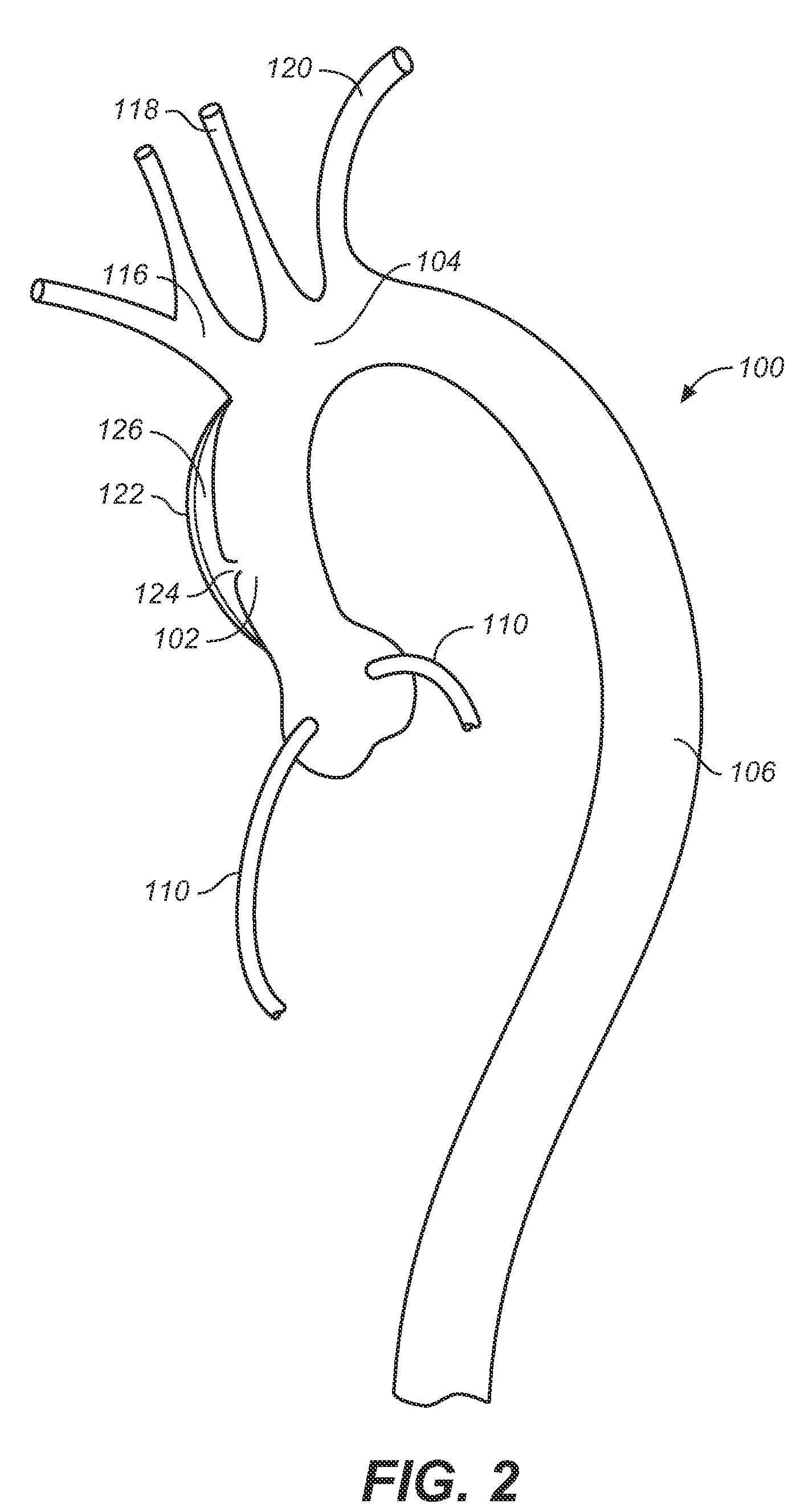 Endovascular Prosthesis for Ascending Aorta