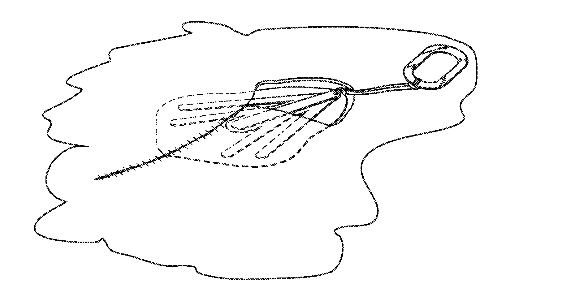 Method and apparatus for assisting in wound closure