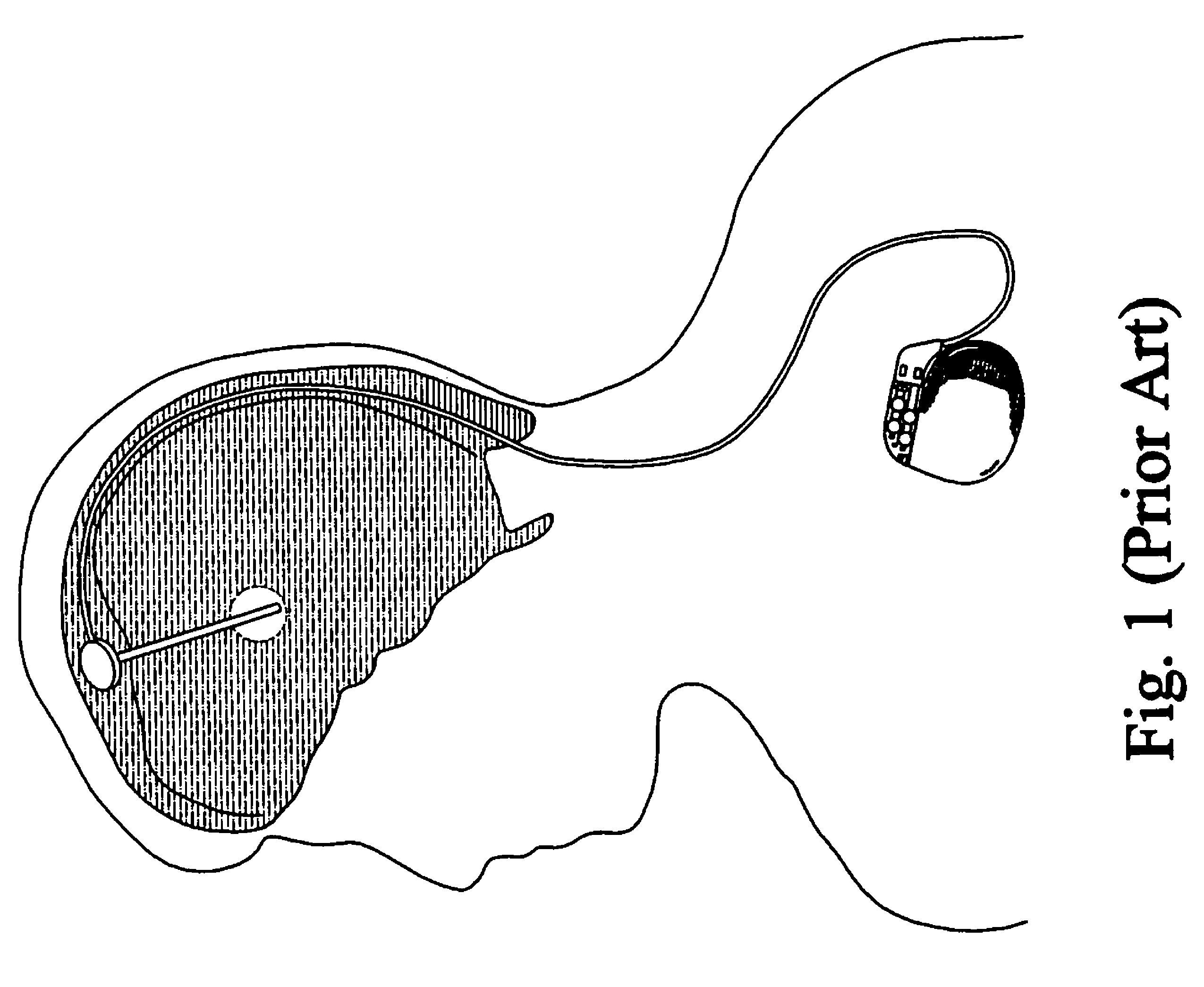 Spatial-temporal deep brain stimulation methods and systems