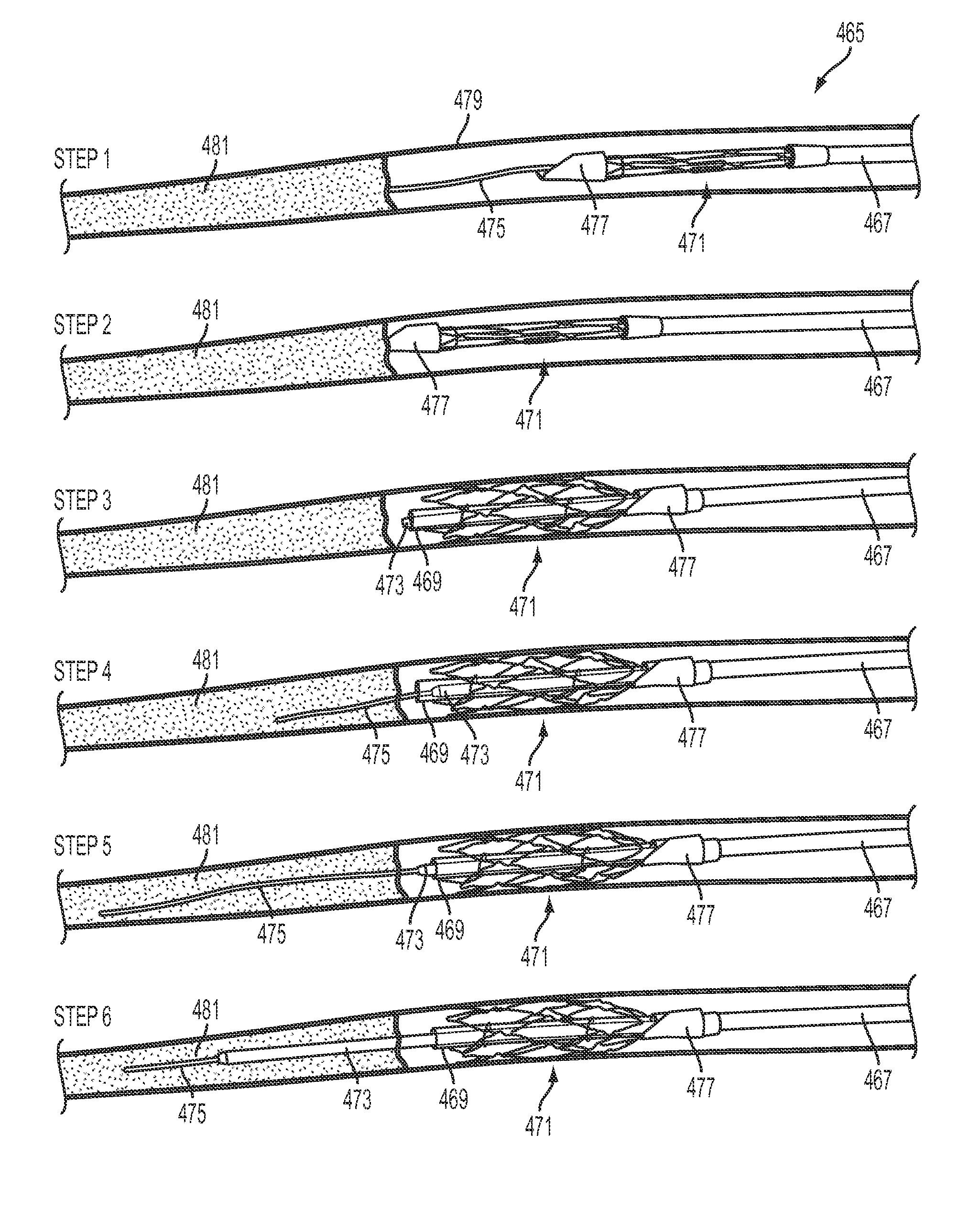 Method and apparatus for centering a microcatheter within a vasculature