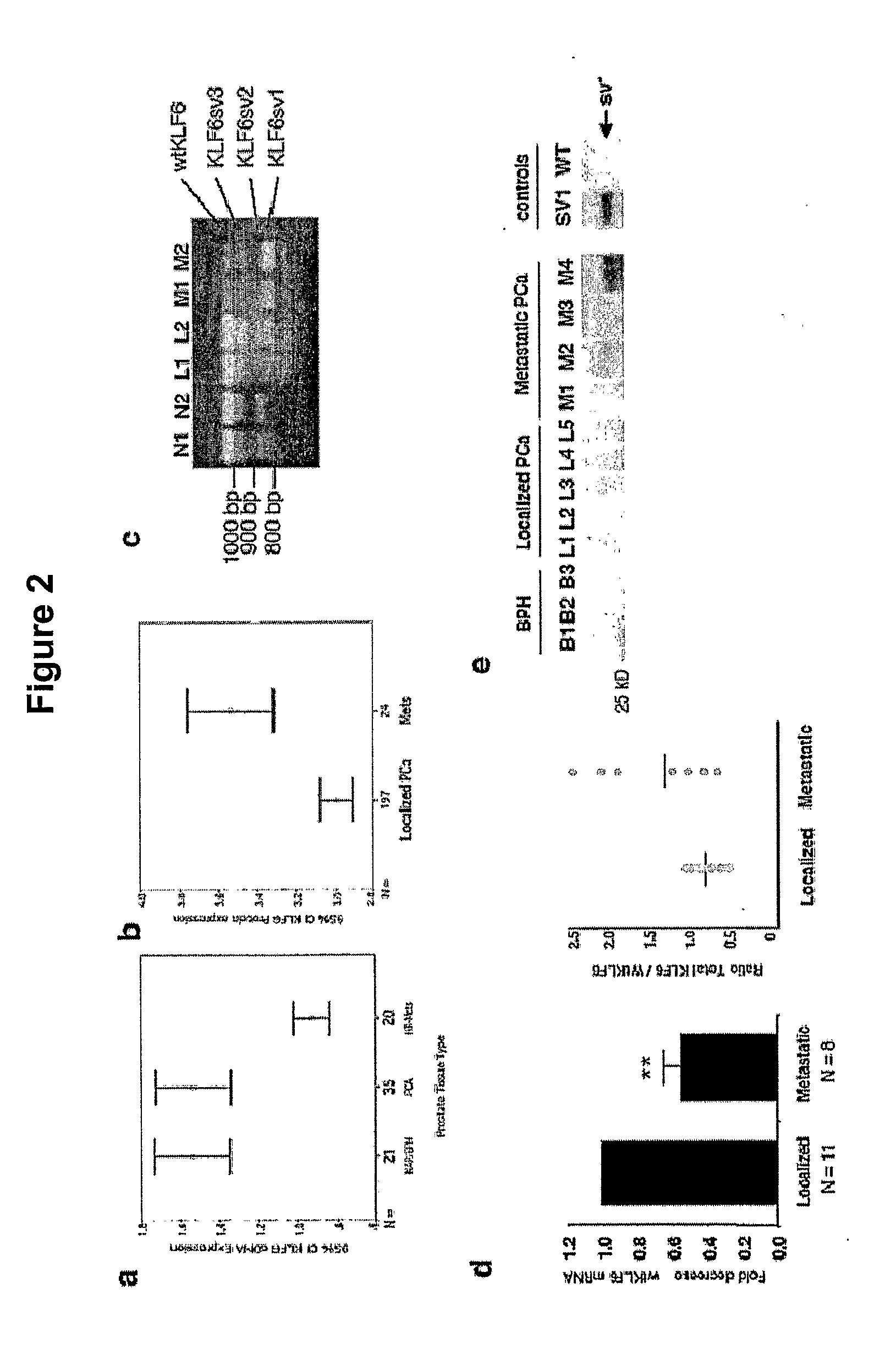 Klf6 alternative splice forms and a germline klf6 DNA polymorphism associated with increased cancer risk