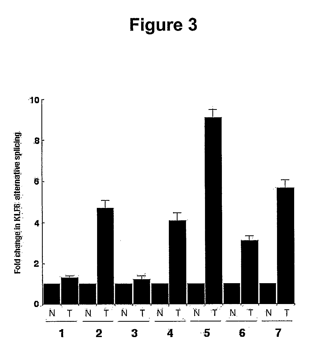 Klf6 alternative splice forms and a germline klf6 DNA polymorphism associated with increased cancer risk