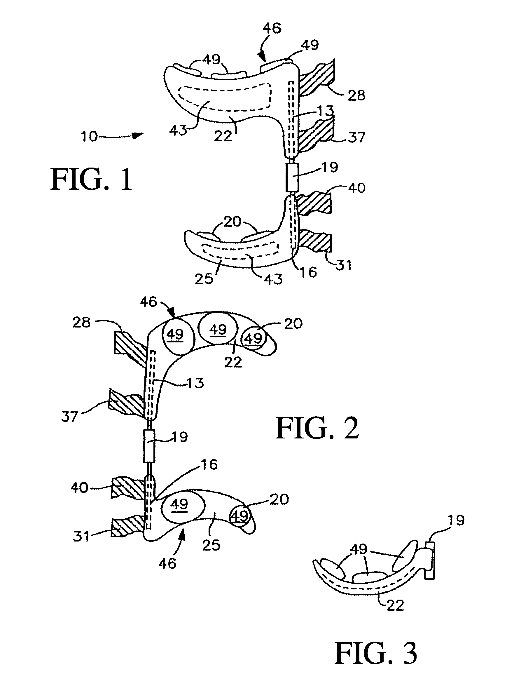 Bracing and electrostimulation for arthritis