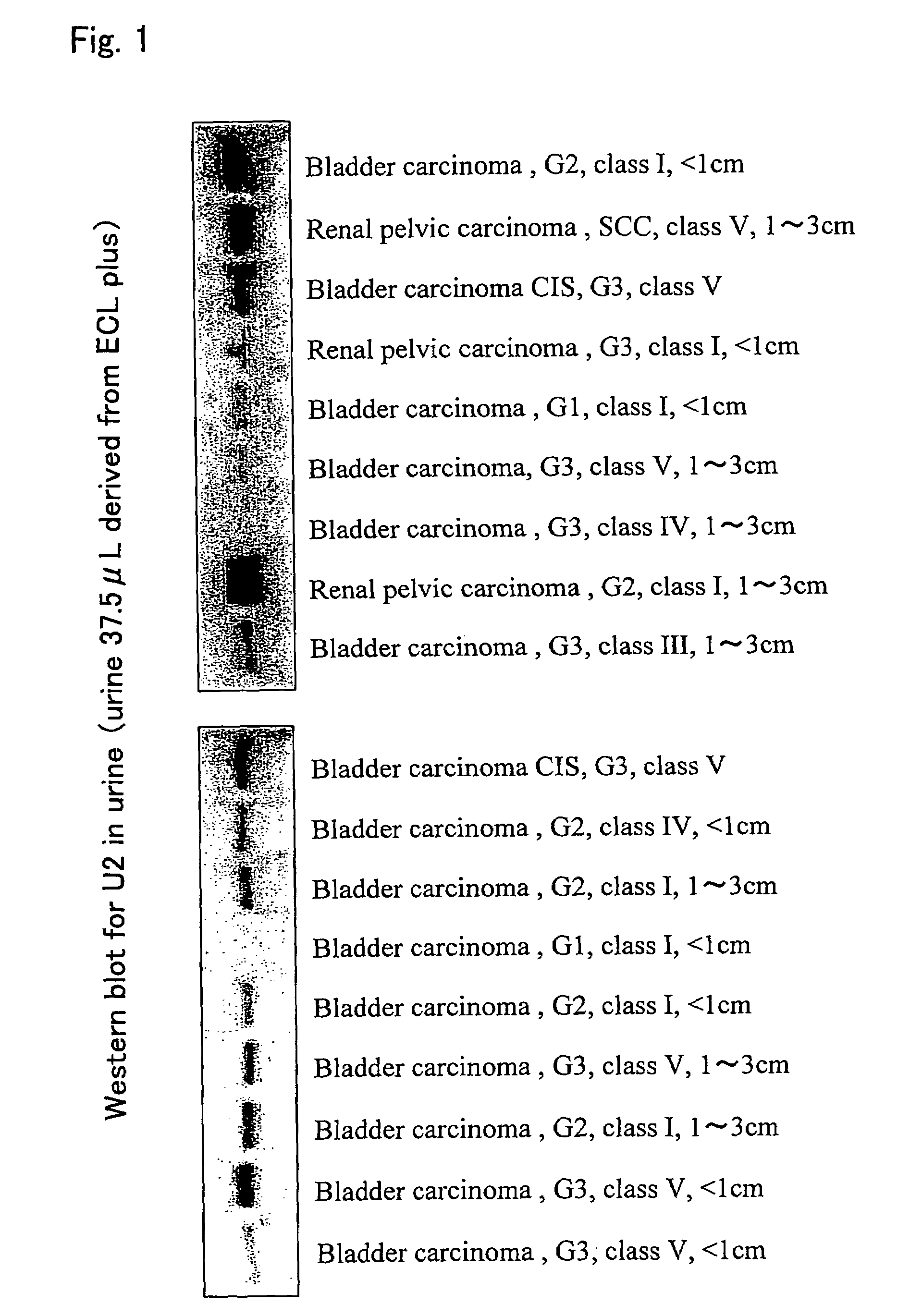 Tumor marker for urothelial carcinoma