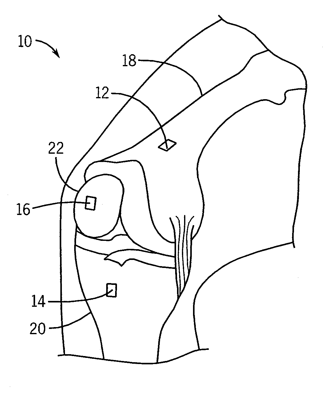 System and method for measurement of clinical parameters of the knee for use during knee replacement surgery