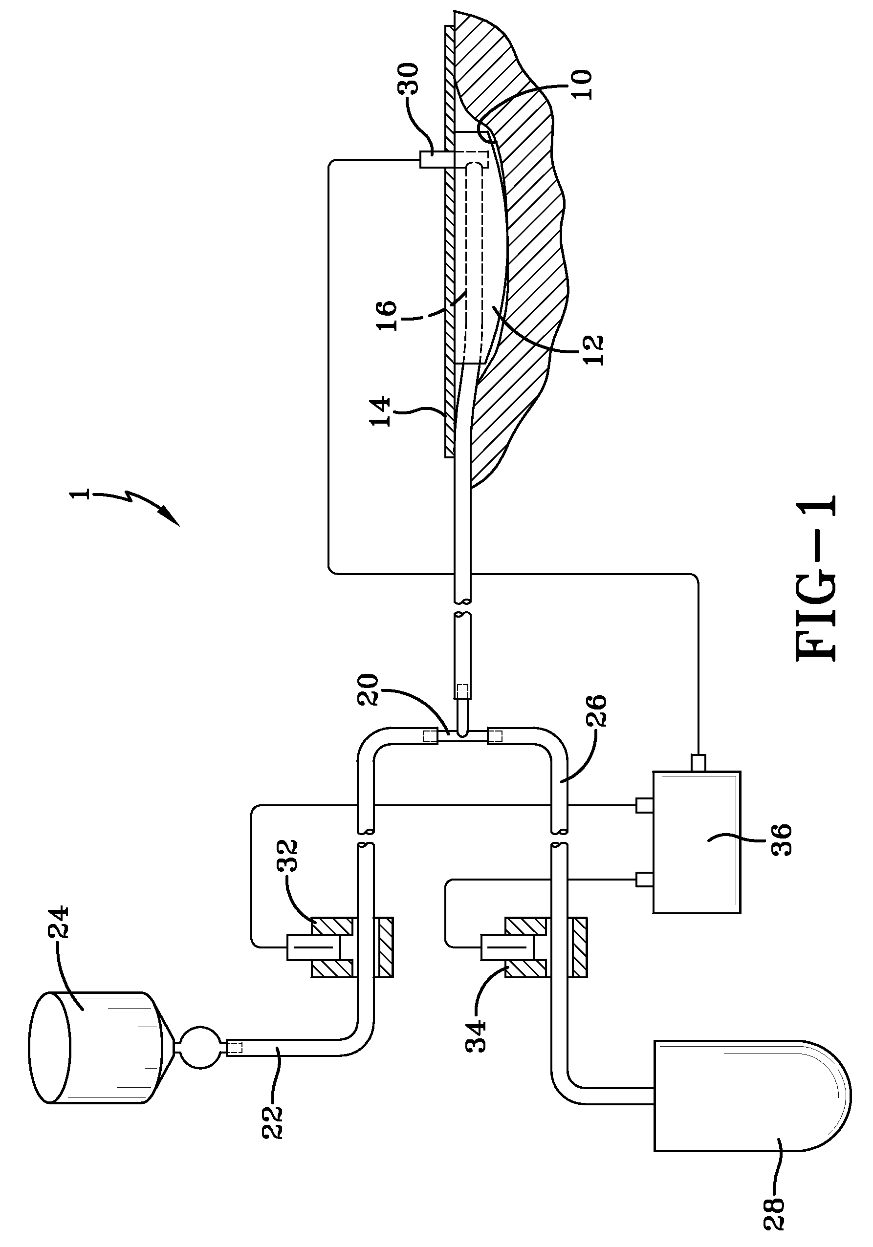 Wound care vacuum bandaging in combination with acoustic shock wave applications