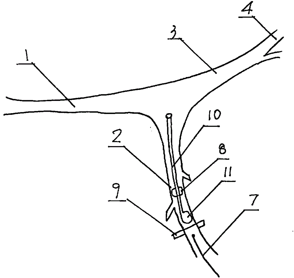 Method for establishing rat external carotid artery catheter-indwelled cerebral ischemia reperfusion model