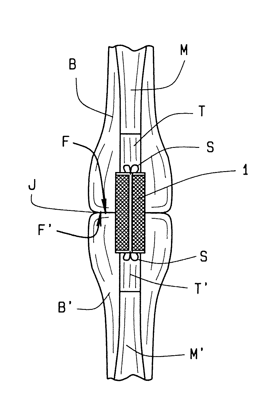 Flexor tendon repair device