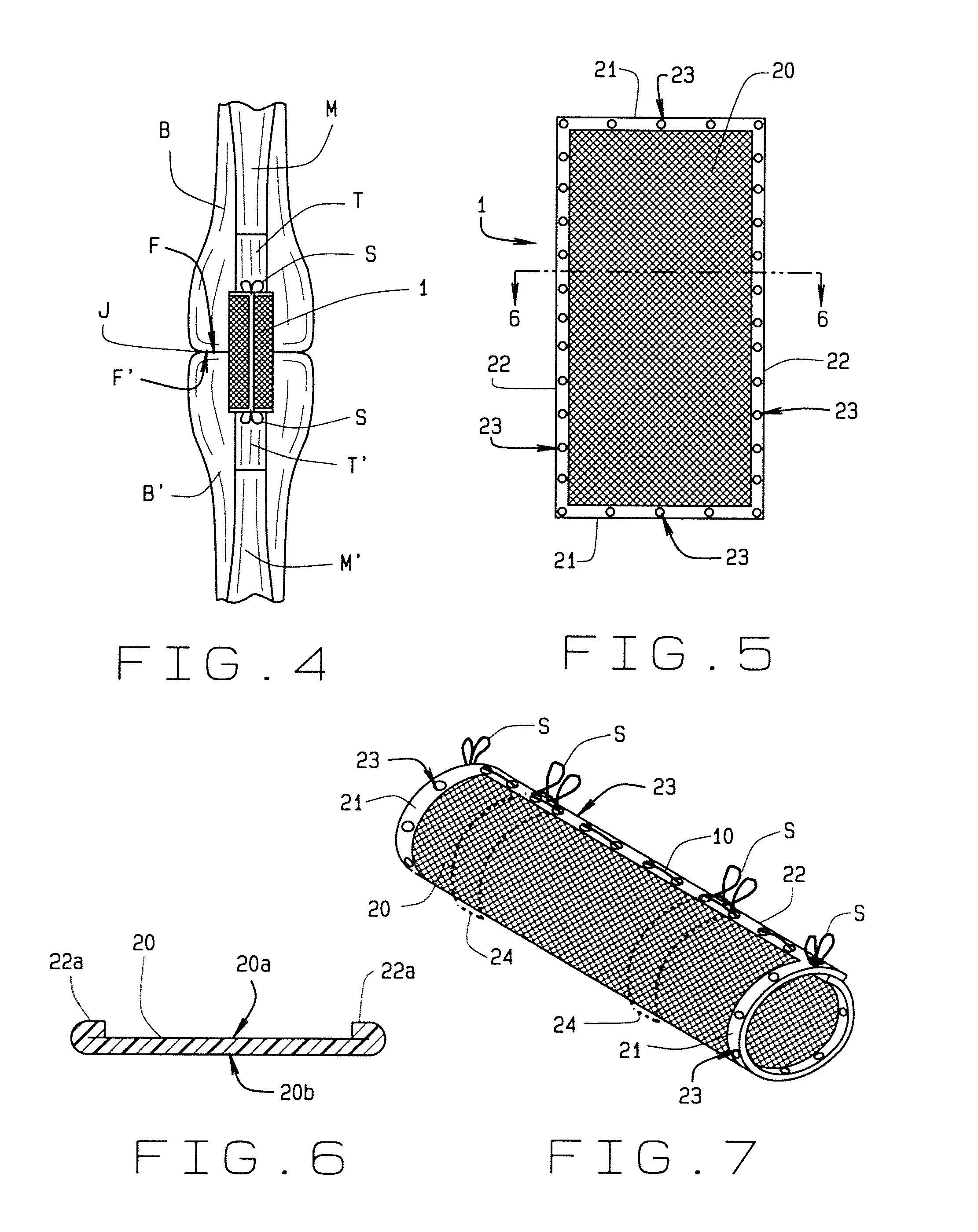 Flexor tendon repair device