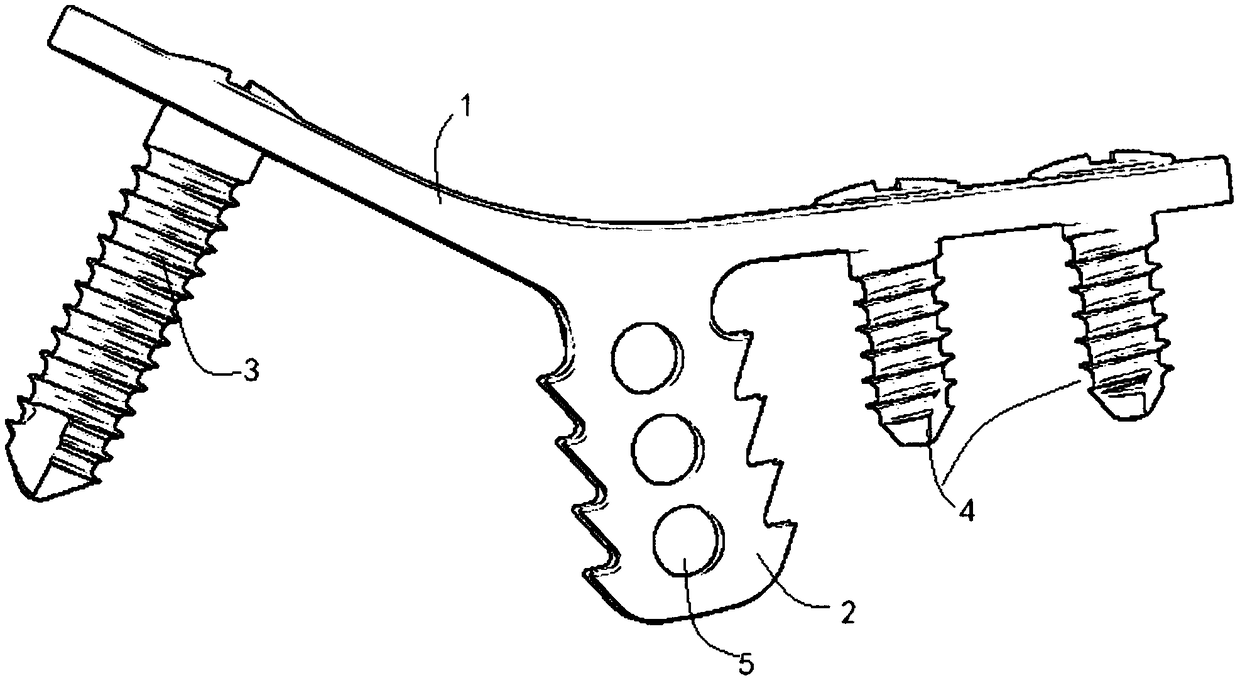 Internal fixation system for cervical posterior vertebral enlargement