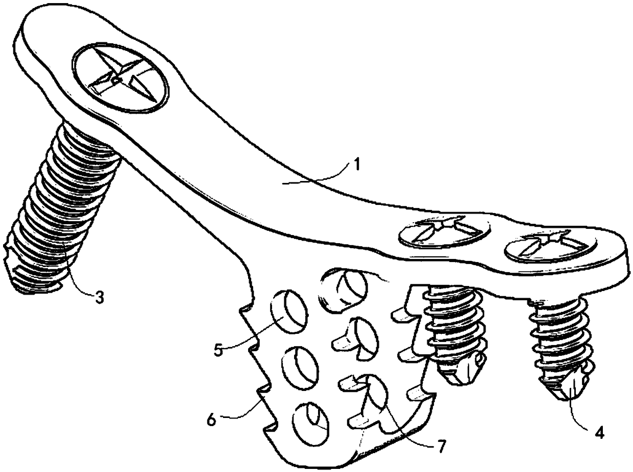 Internal fixation system for cervical posterior vertebral enlargement