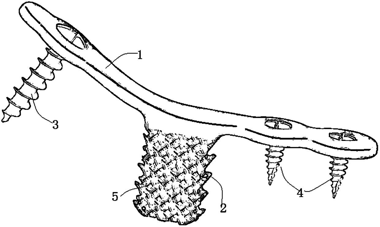 Internal fixation system for cervical posterior vertebral enlargement