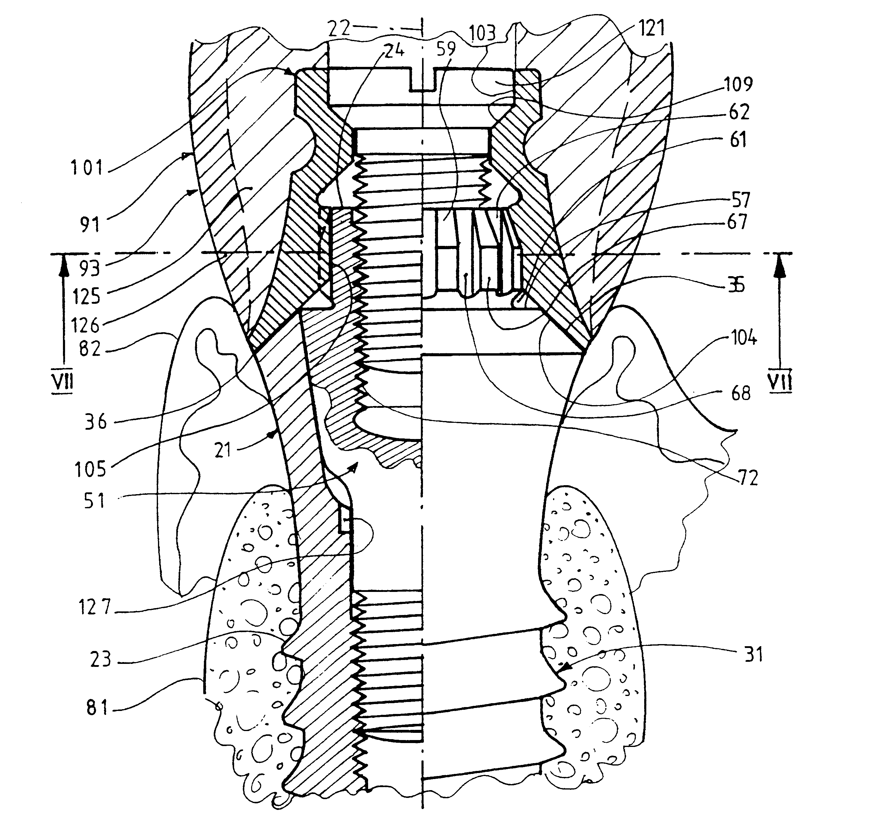 Support for sustaining and/or forming a dental prosthesis