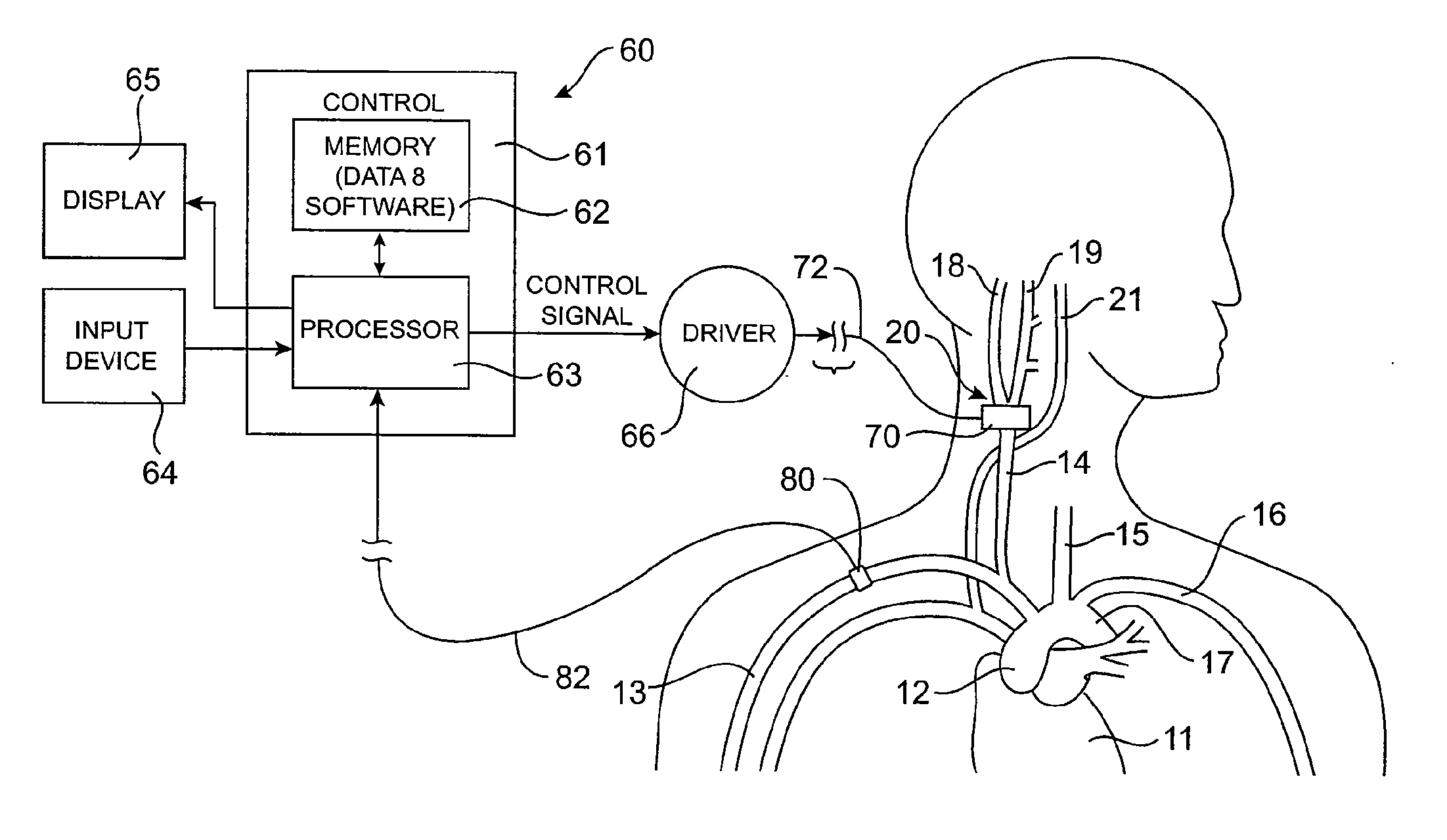 Baroreflex Modulation Based On Monitored Cardiovascular Parameter