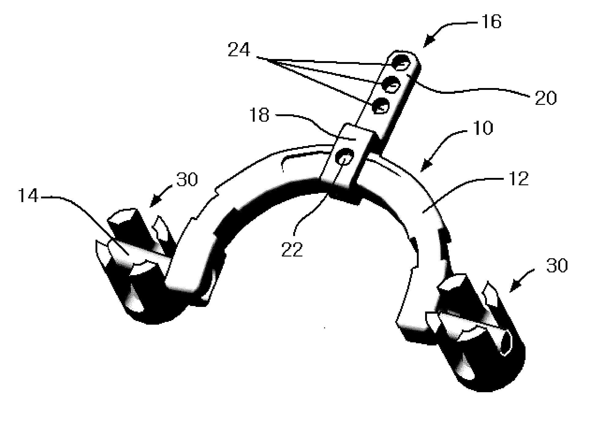 Apparatus for Occipital-Cervical Fixation Enabling Supplemental Occipital Bone Fixation