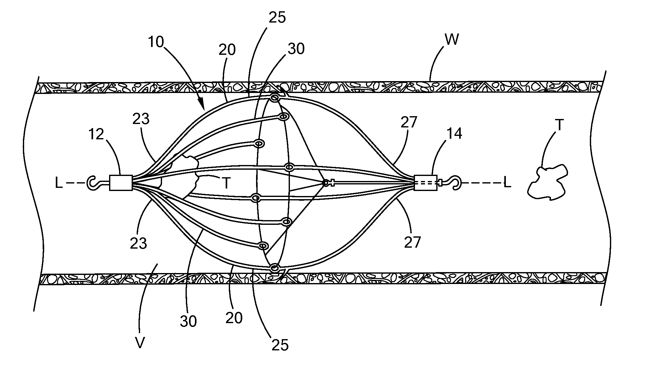 Conical vena cava filter with jugular or femoral retrieval