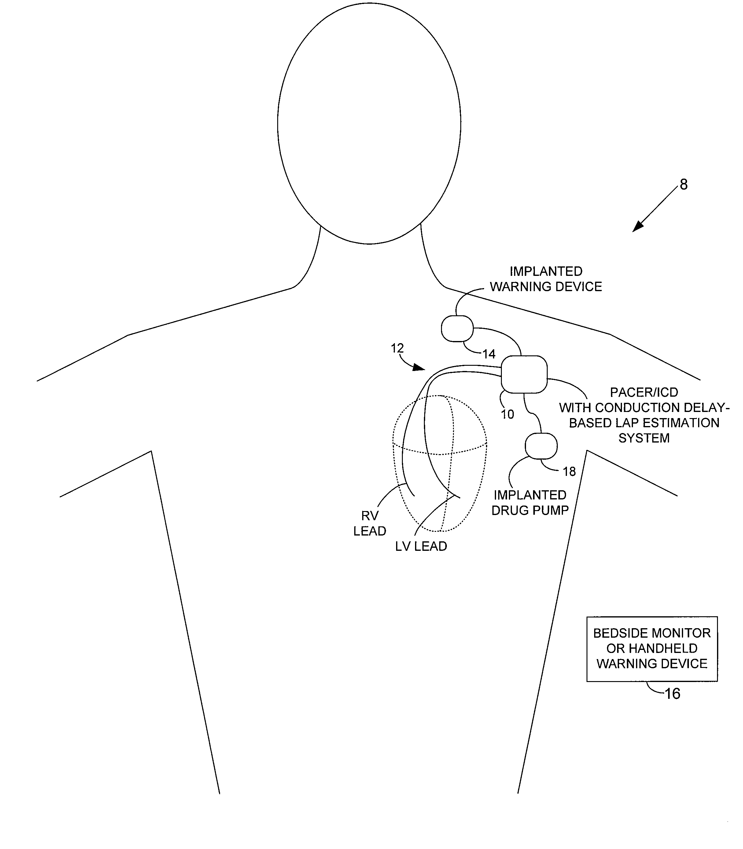 System and method for estimating cardiac pressure based on cardiac electrical conduction delays using an implantable medical device