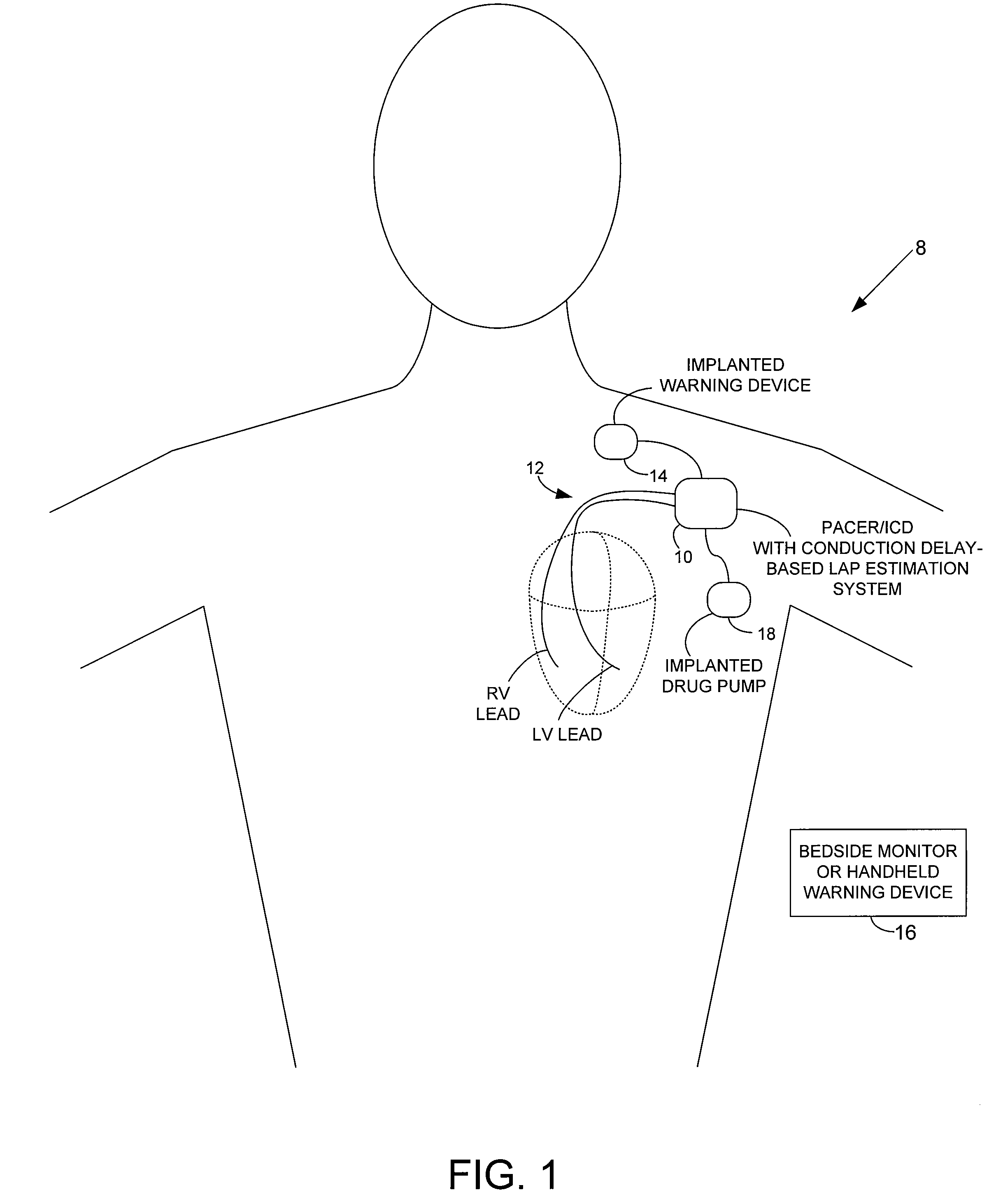 System and method for estimating cardiac pressure based on cardiac electrical conduction delays using an implantable medical device