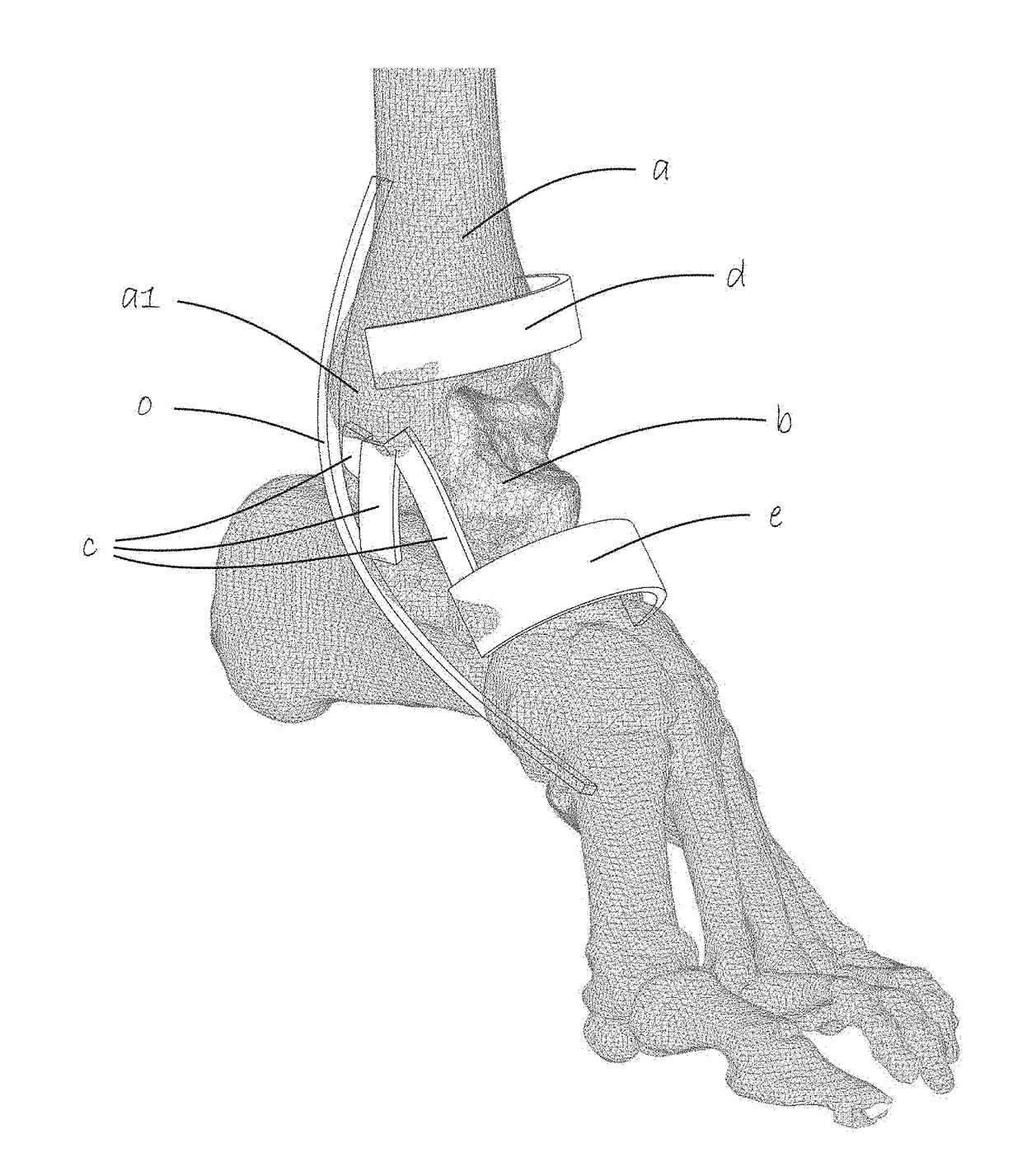 Tools for assisting in osteotomy procedures, and methods for designing and manufacturing osteotomy tools