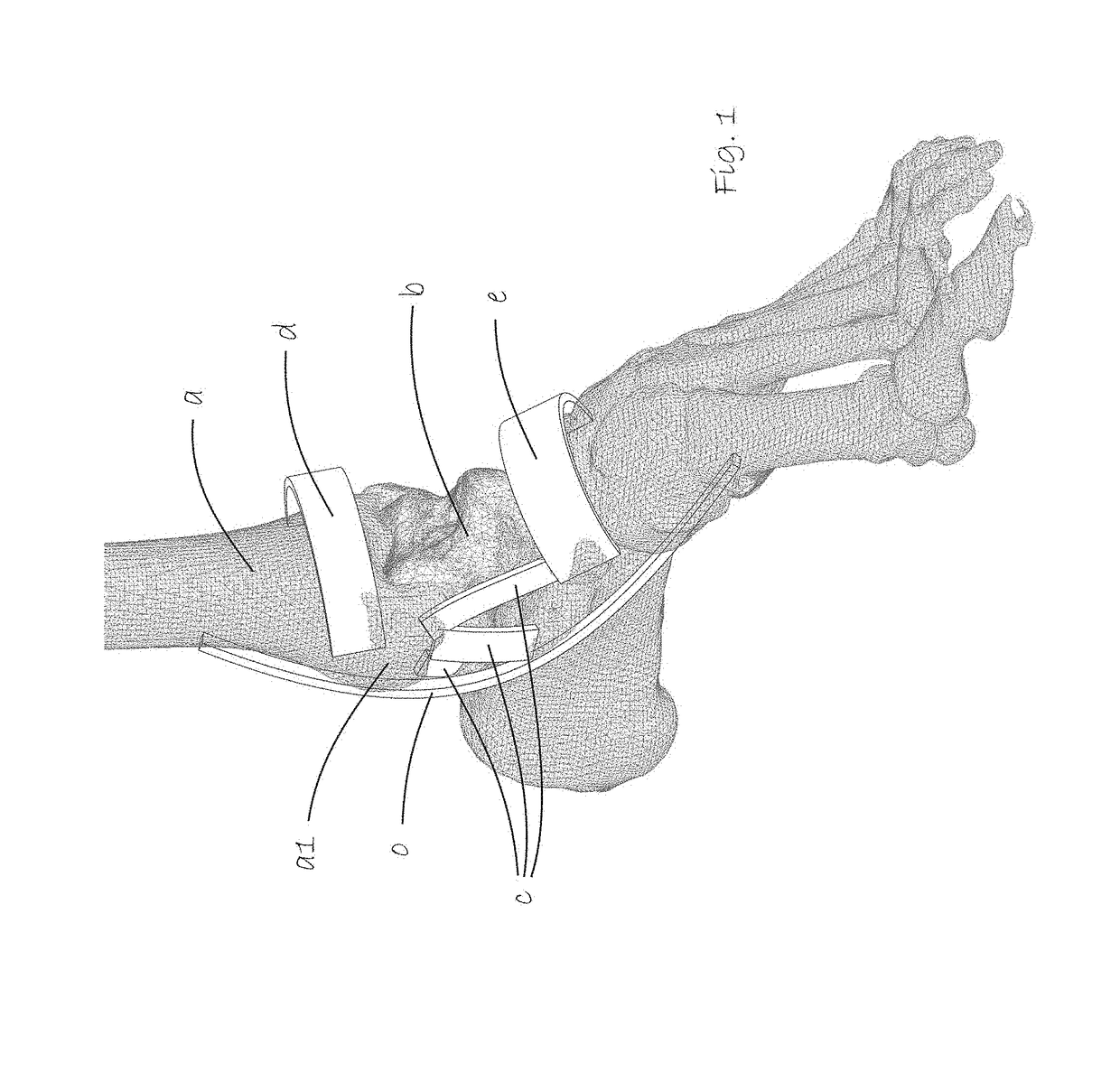 Tools for assisting in osteotomy procedures, and methods for designing and manufacturing osteotomy tools