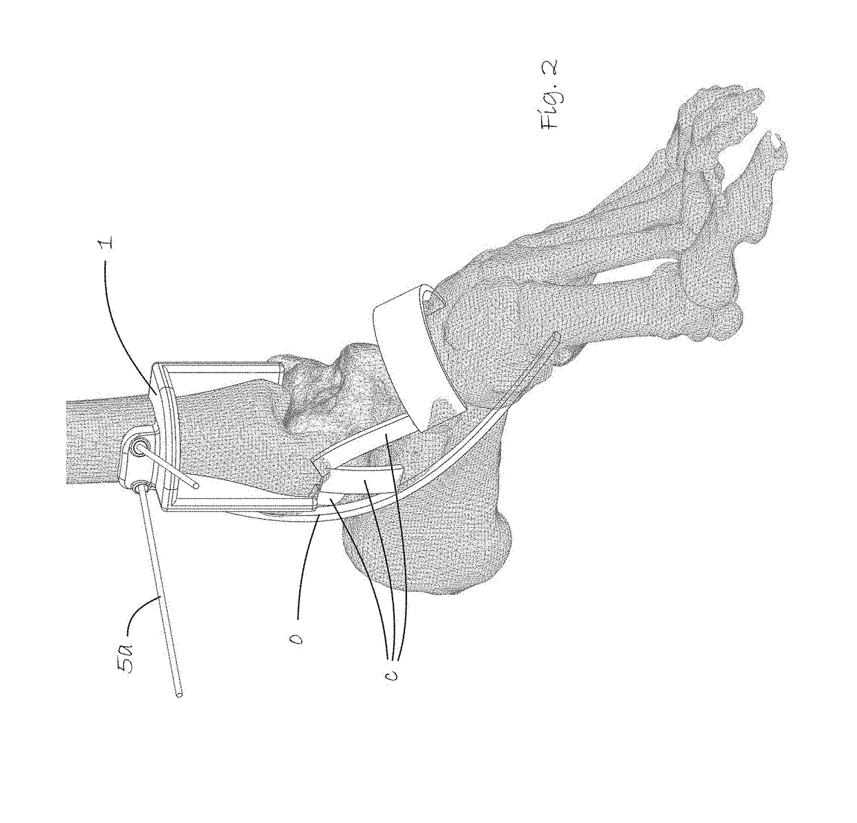 Tools for assisting in osteotomy procedures, and methods for designing and manufacturing osteotomy tools