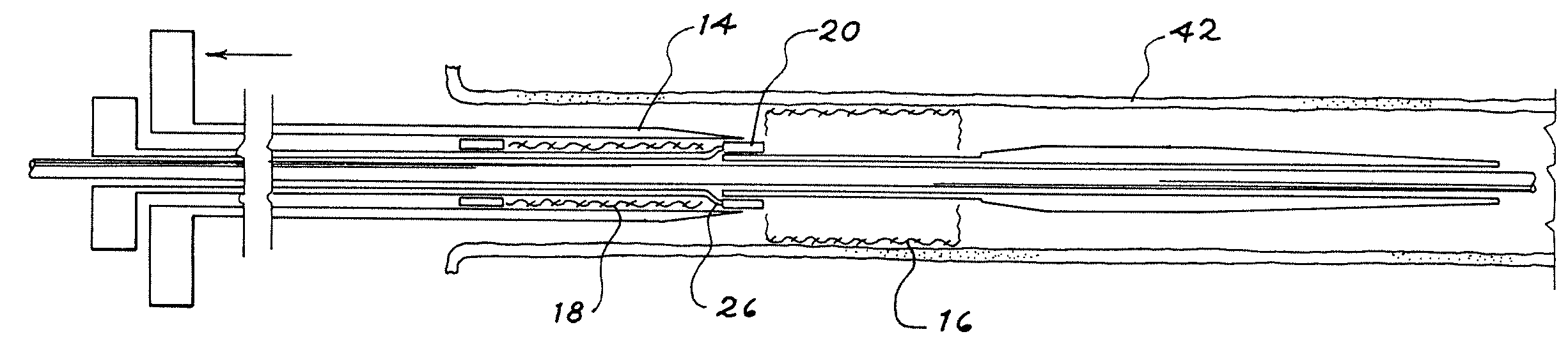 Sequential implant delivery system