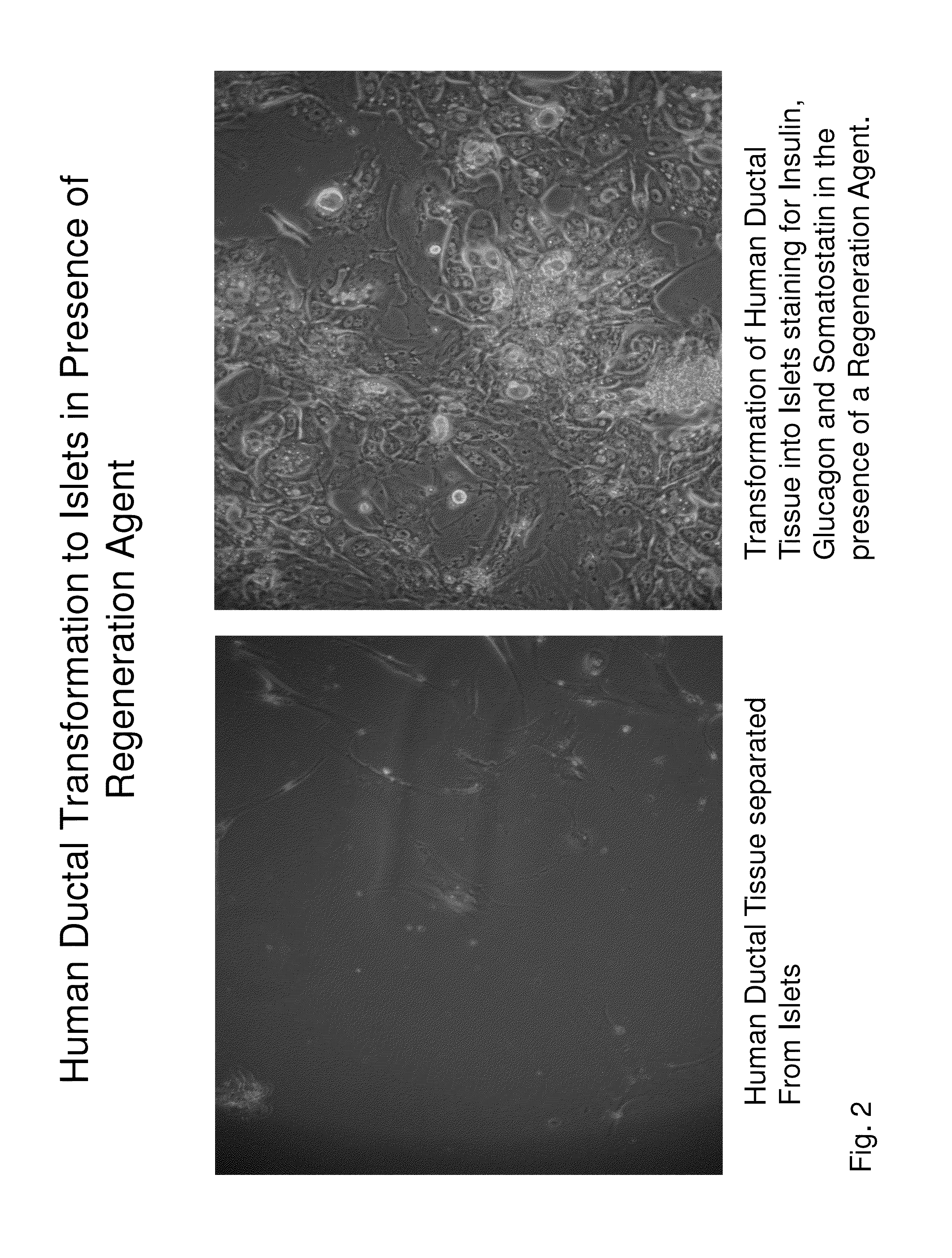 Insulin independence among patients with diabetes utilizing a ppi in combination with an immune tolerance agent