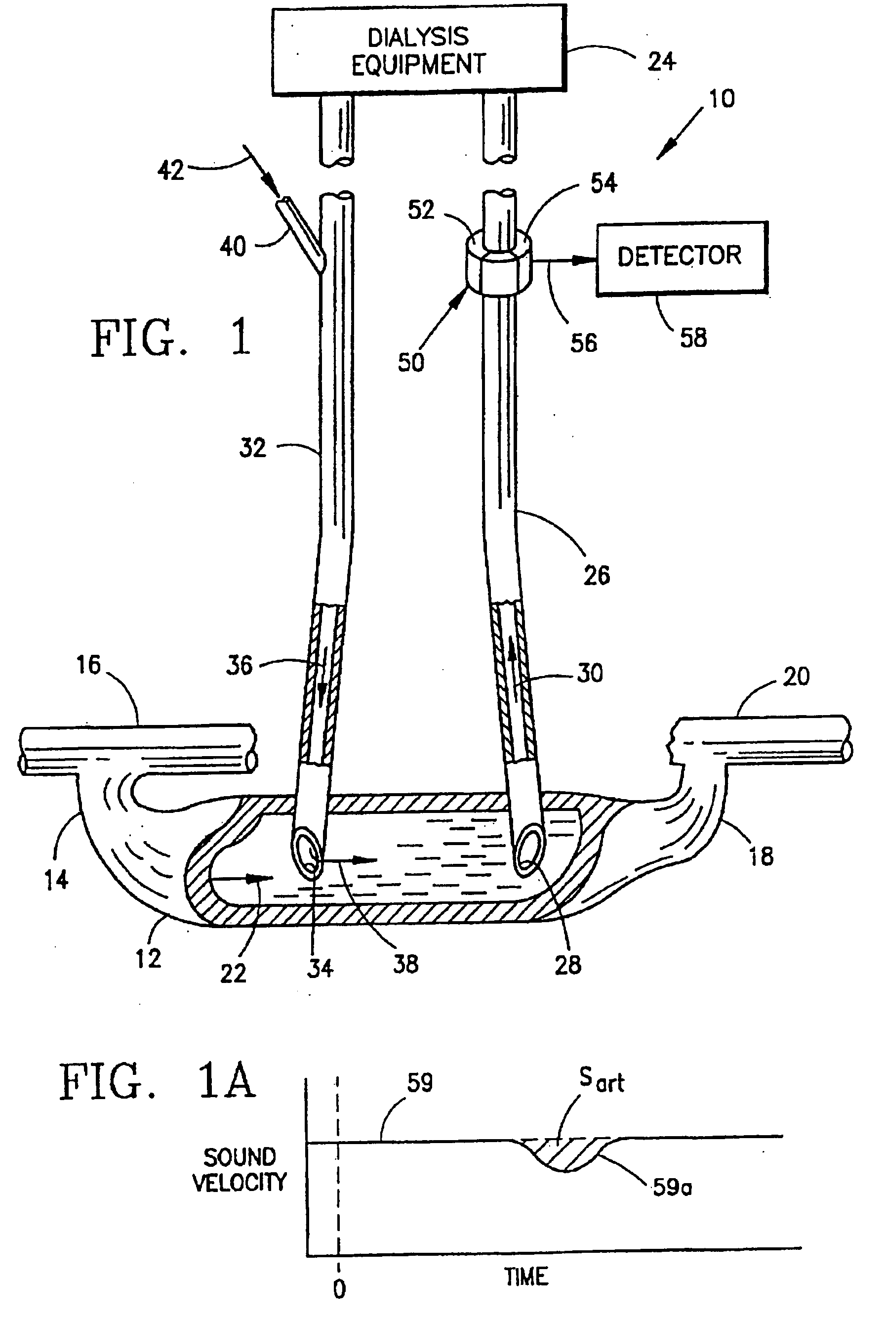 Measurement of a blood flow rate in hemodialysis shunts