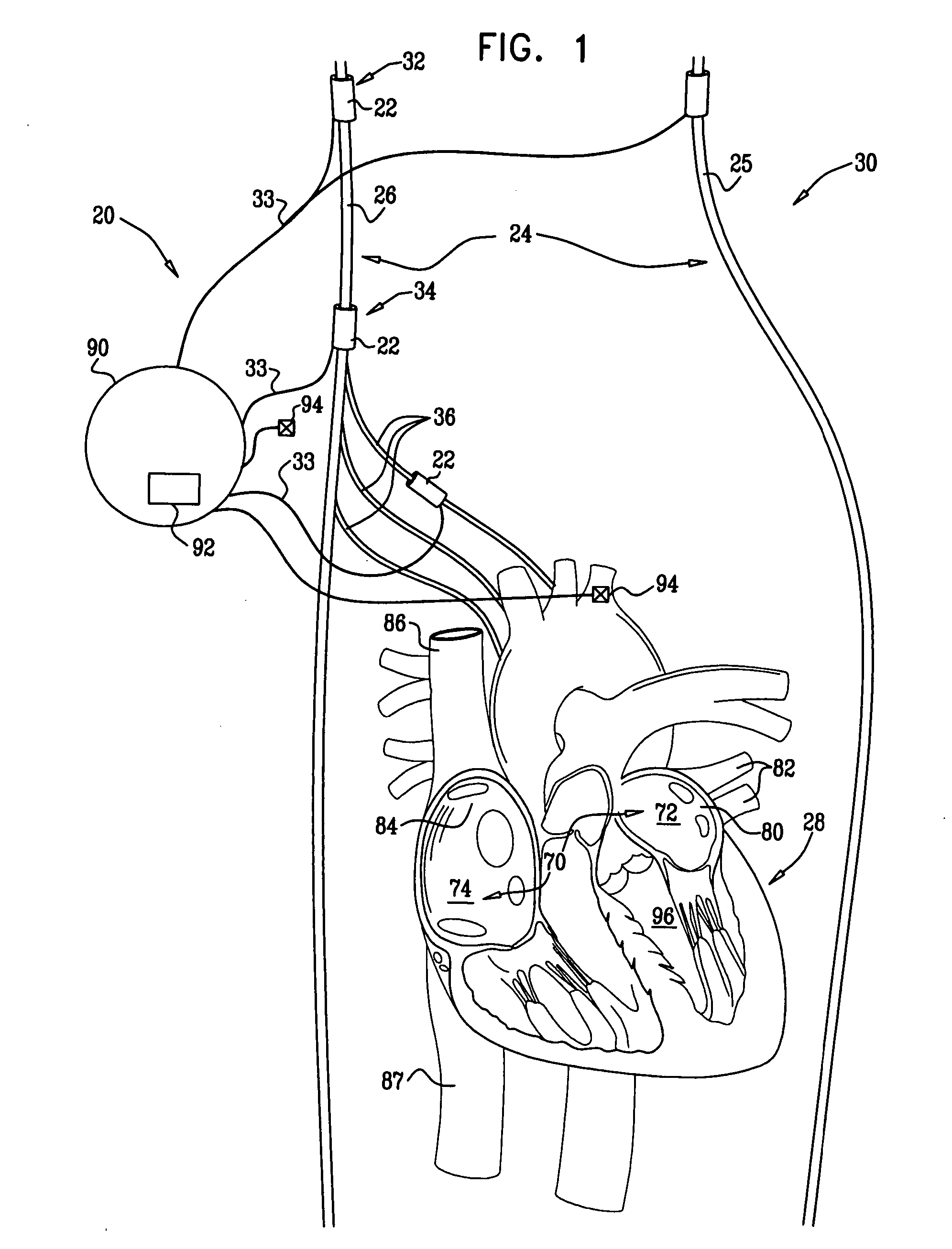 Intravascular parasympatheticstimulation for atrial cardioversion