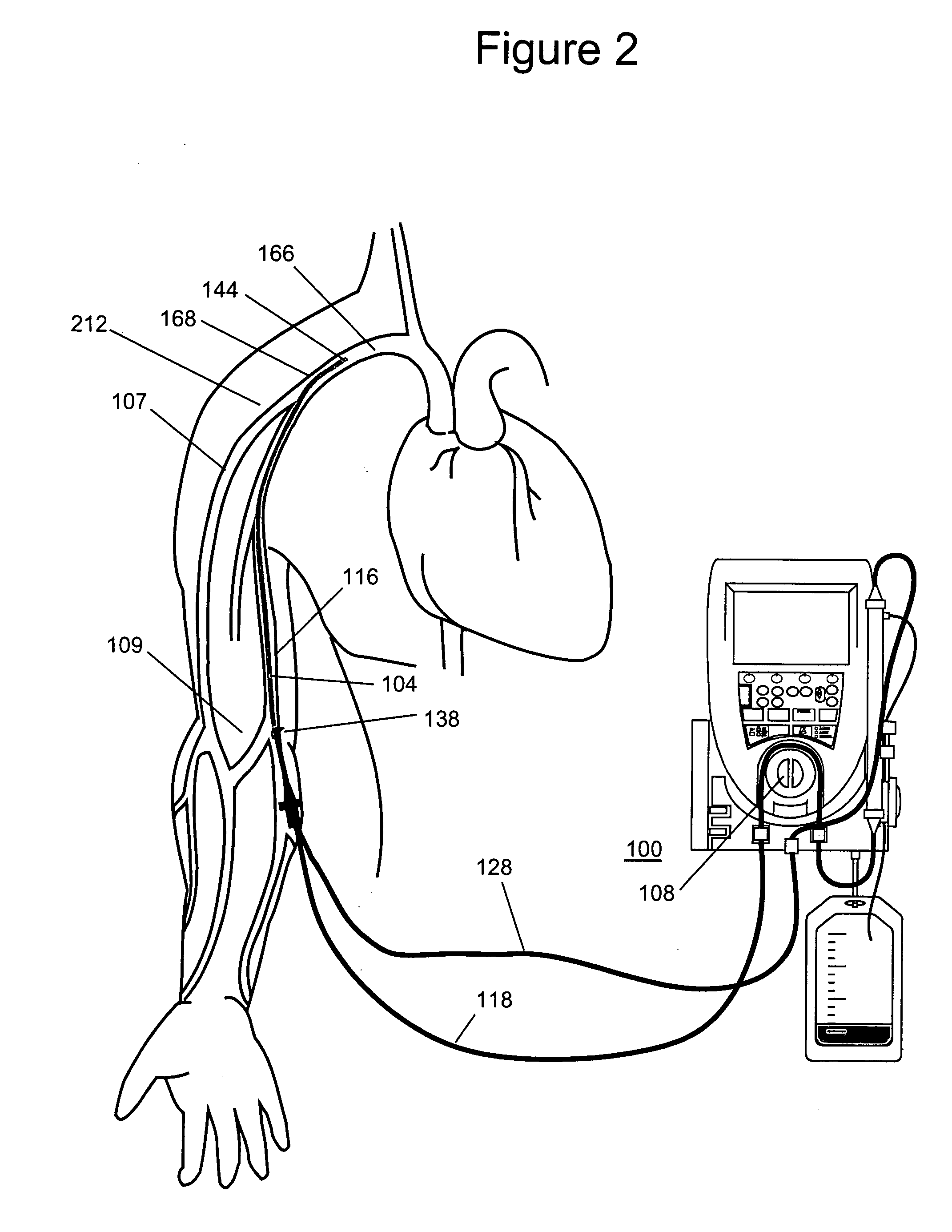 Method and apparatus for ultrafiltration utilizing a peripheral access dual lumen venous cannula