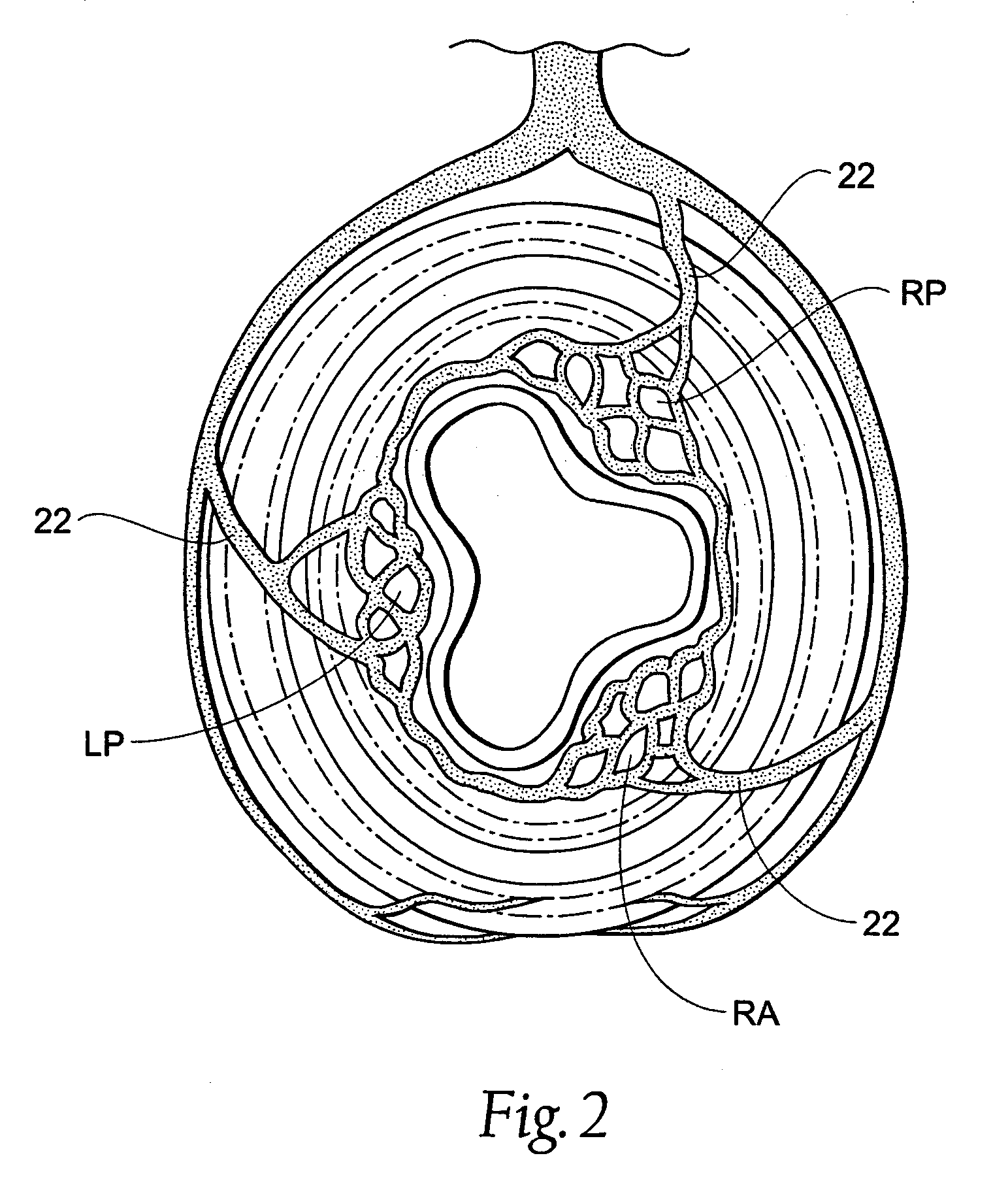 Systems and methods for treating hemorrhoids