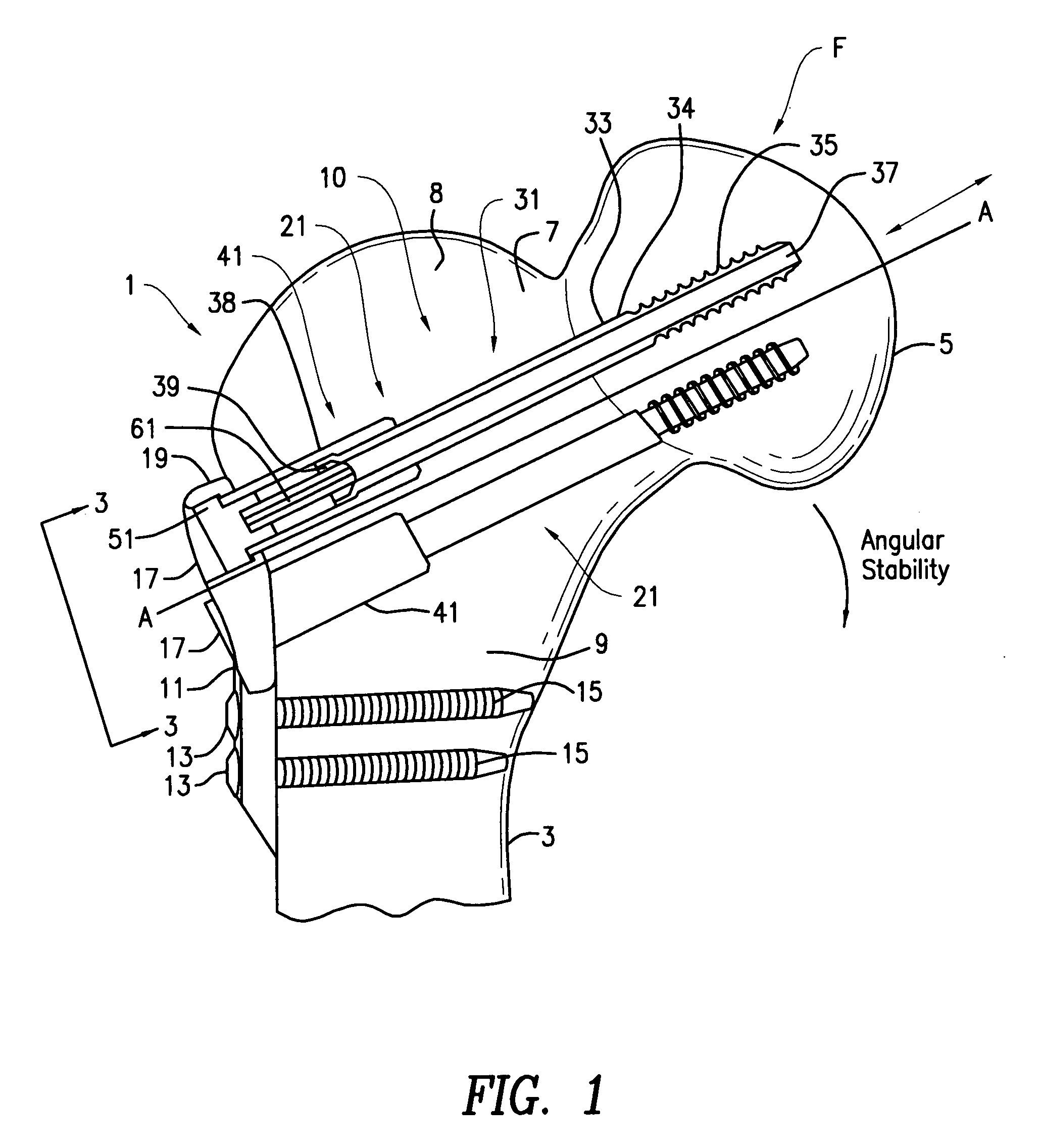 Hip fracture device with barrel and end cap for load control