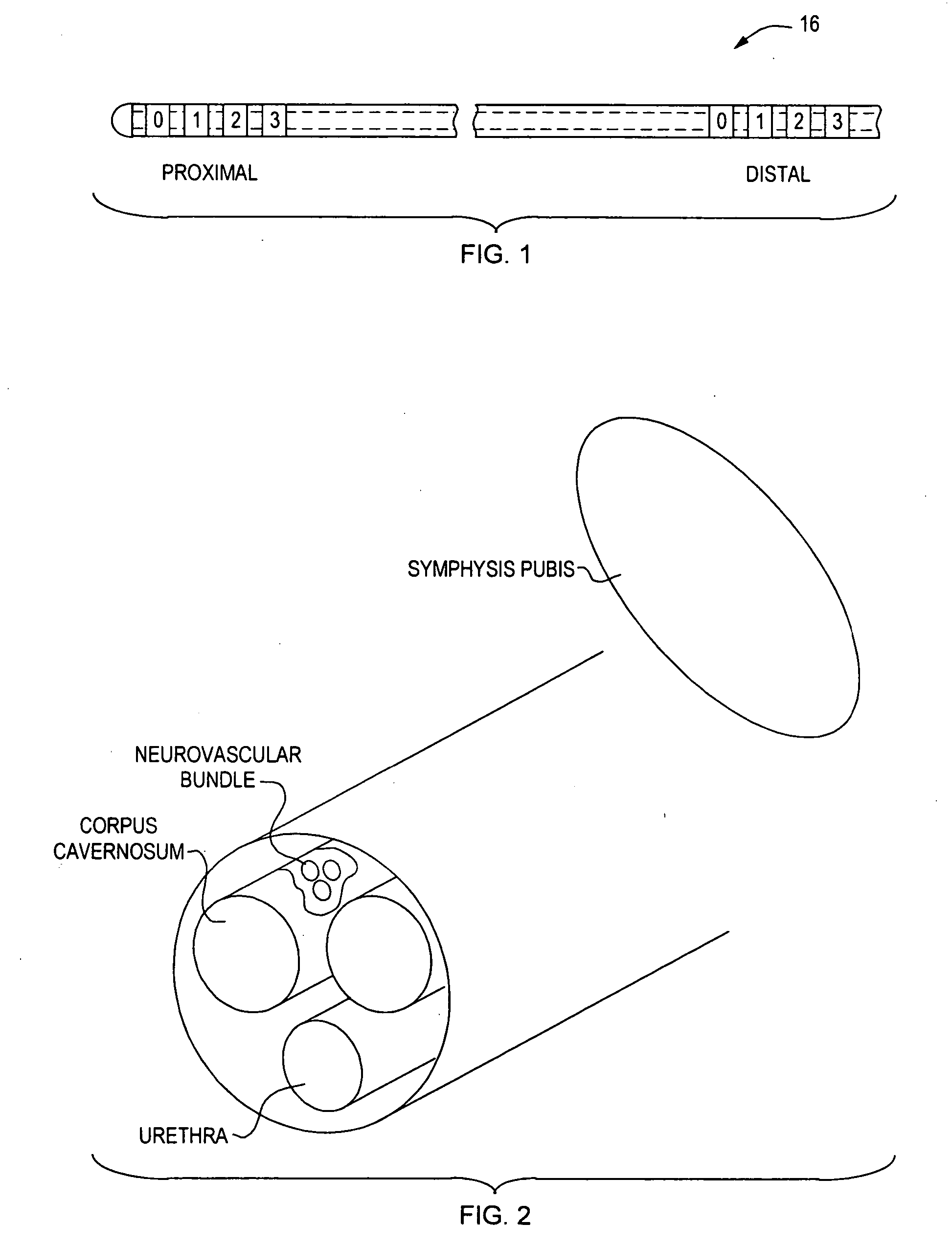 Implantable device and method for managing erectile dysfunction