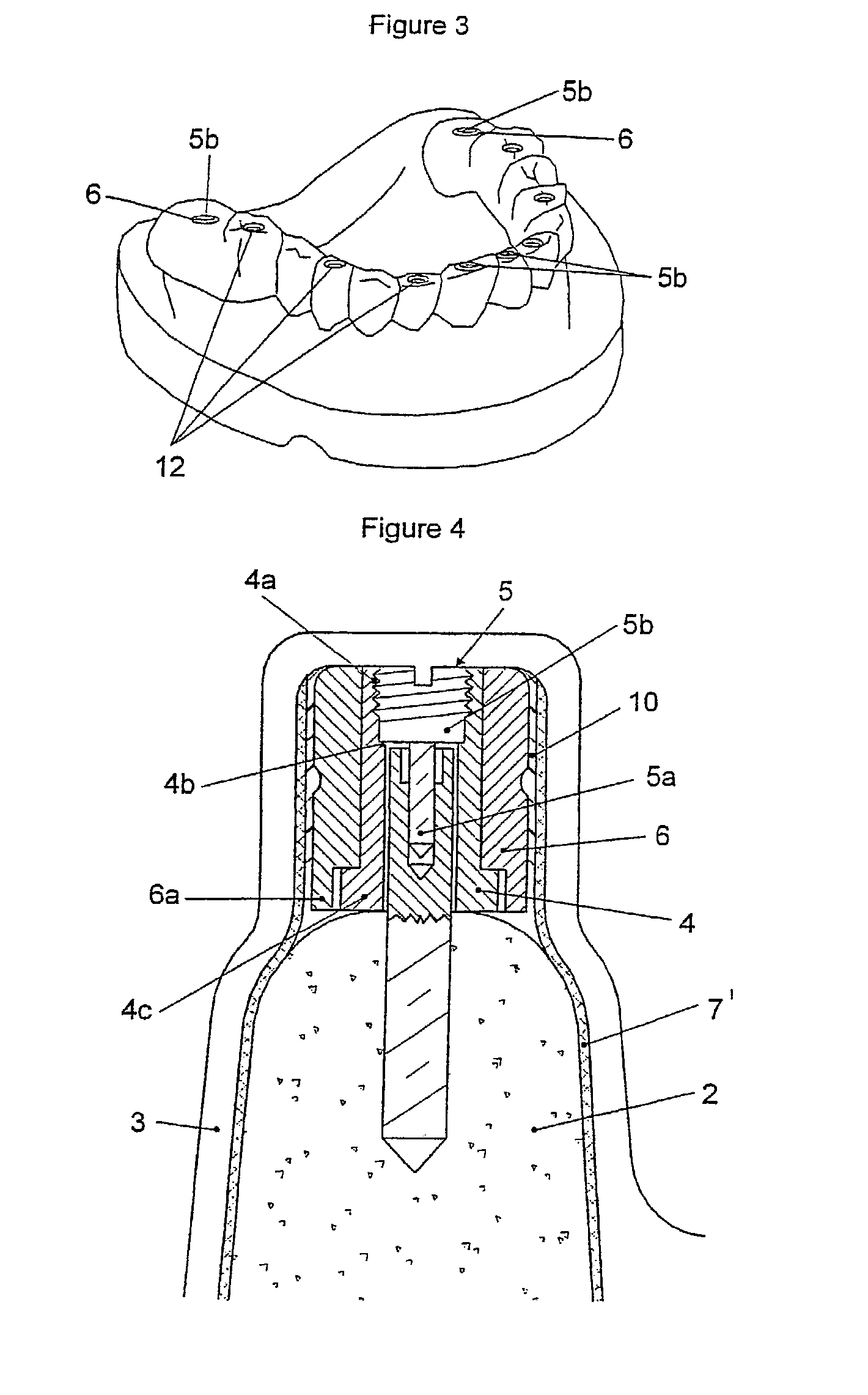 Positioning device for fitting implant-supported dental prostheses