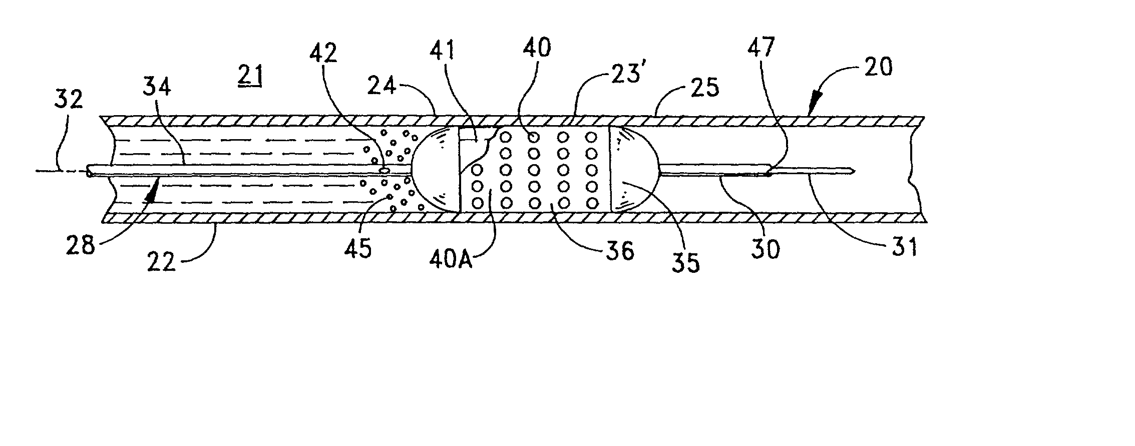 Replenishable stent and delivery system