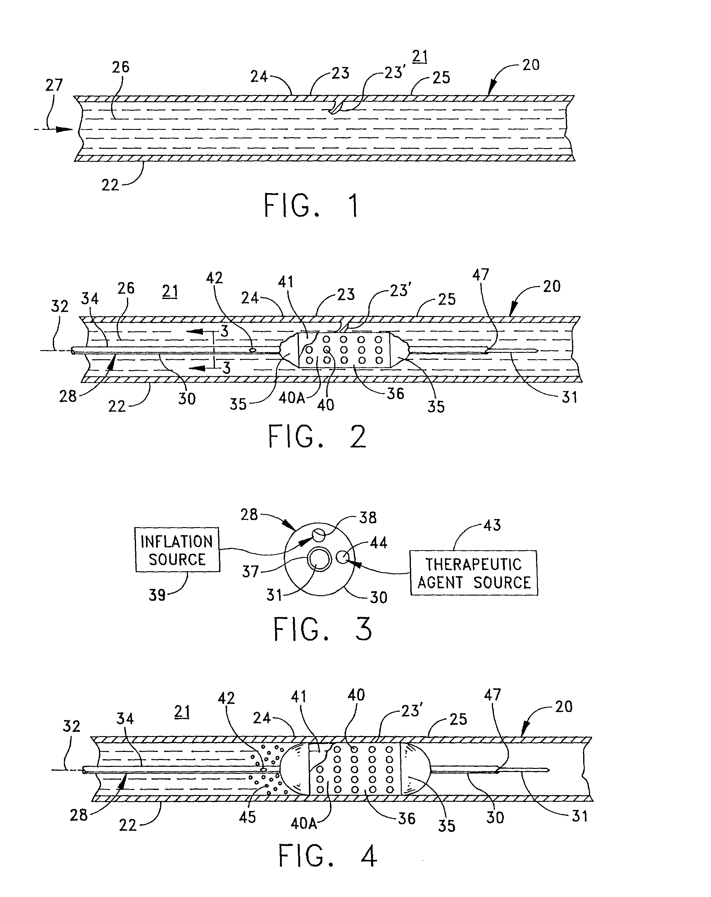 Replenishable stent and delivery system