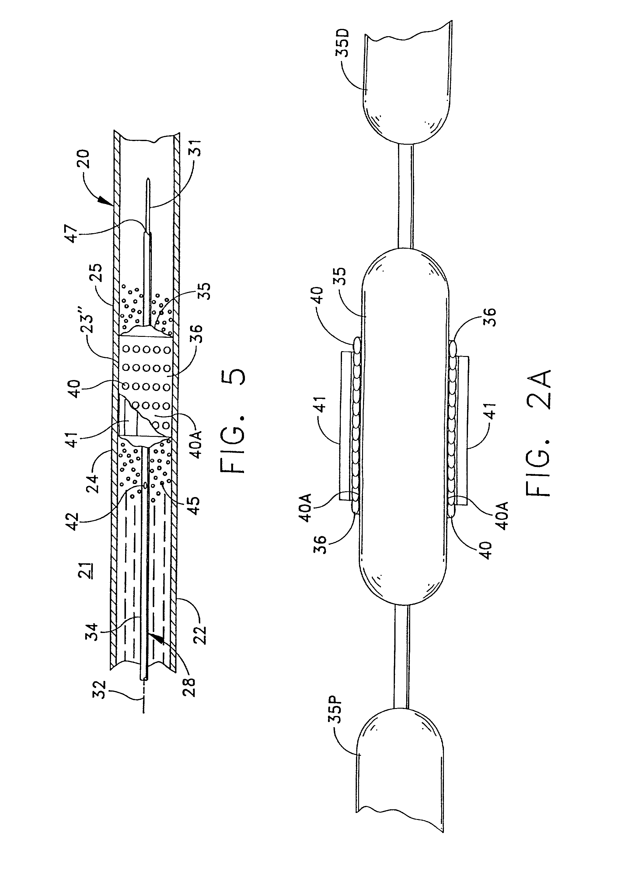 Replenishable stent and delivery system