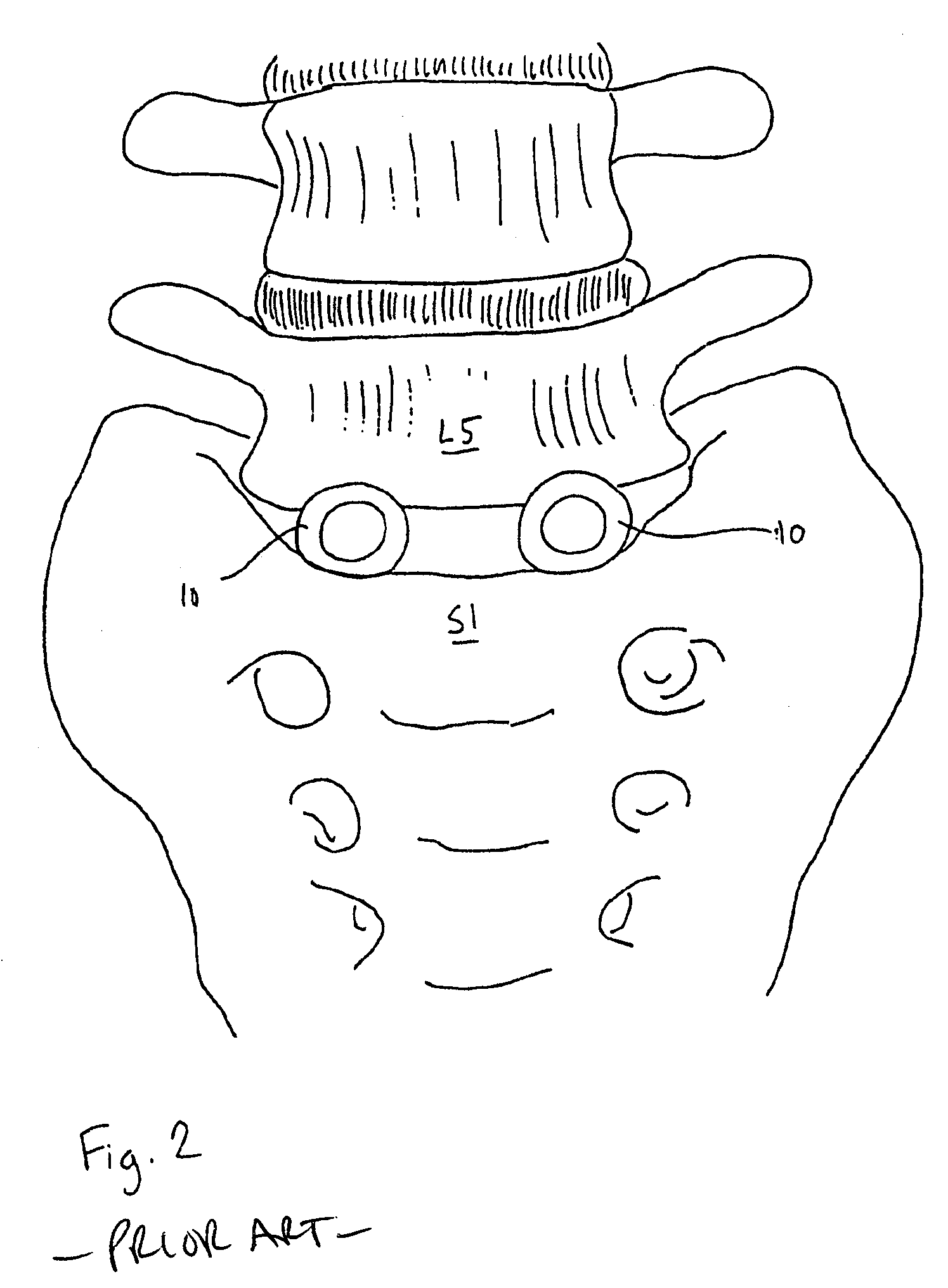 Intervertebral spacer device utilizing a belleville washer having radially extending grooves